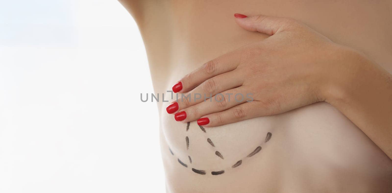 Close-up of client close breast with hand, marking on boob for cosmetic surgery operation. Patient prepare for procedure in clinic. Plastic surgery concept