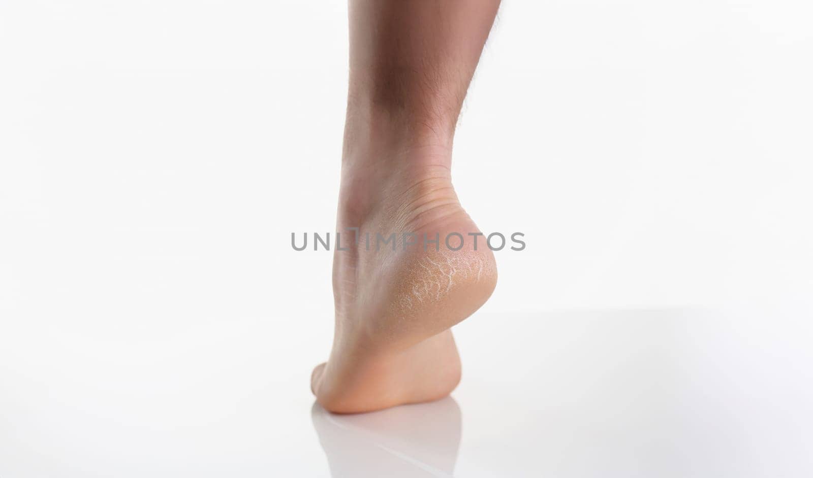 Close-up of single female leg or heel showing dried cracked heel with dried skin. Cracked womans heels during winter season. Wellness, self care concept