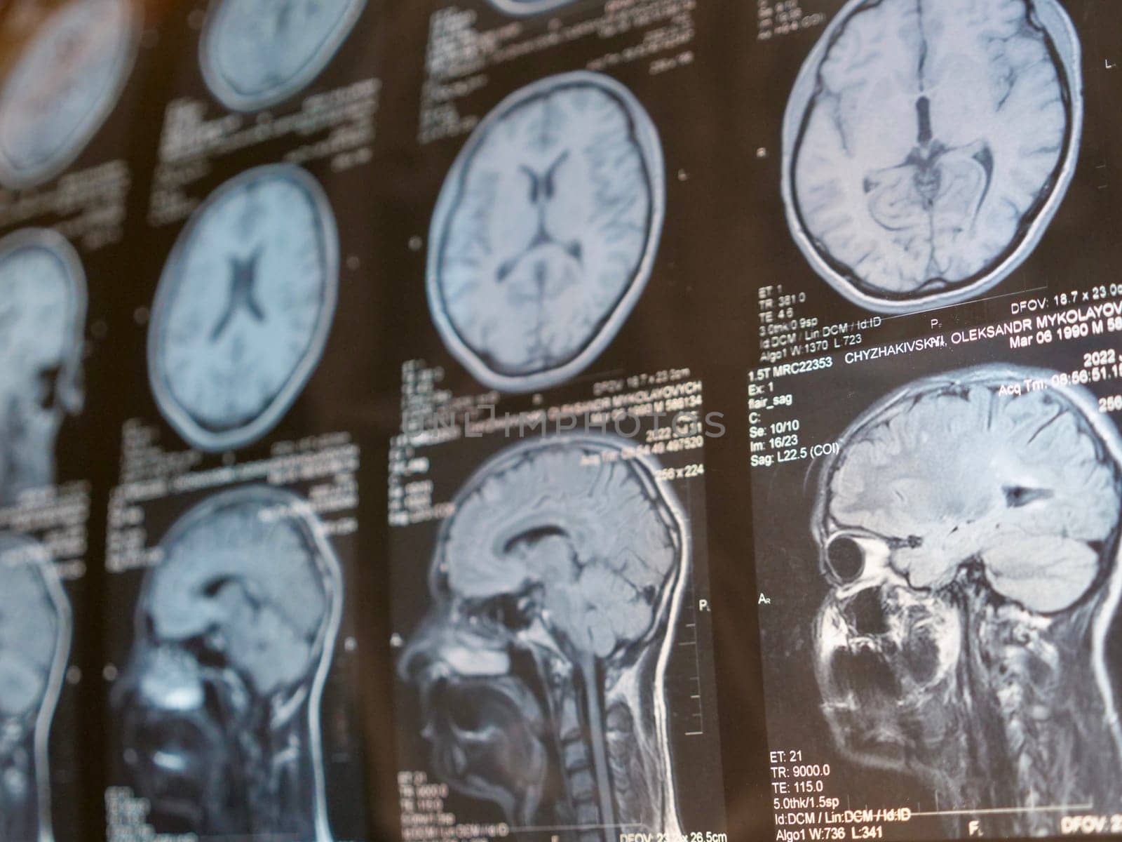 MRI of the human brain of a patient with multiple sclerosis of the initial stage. Close-up X-ray