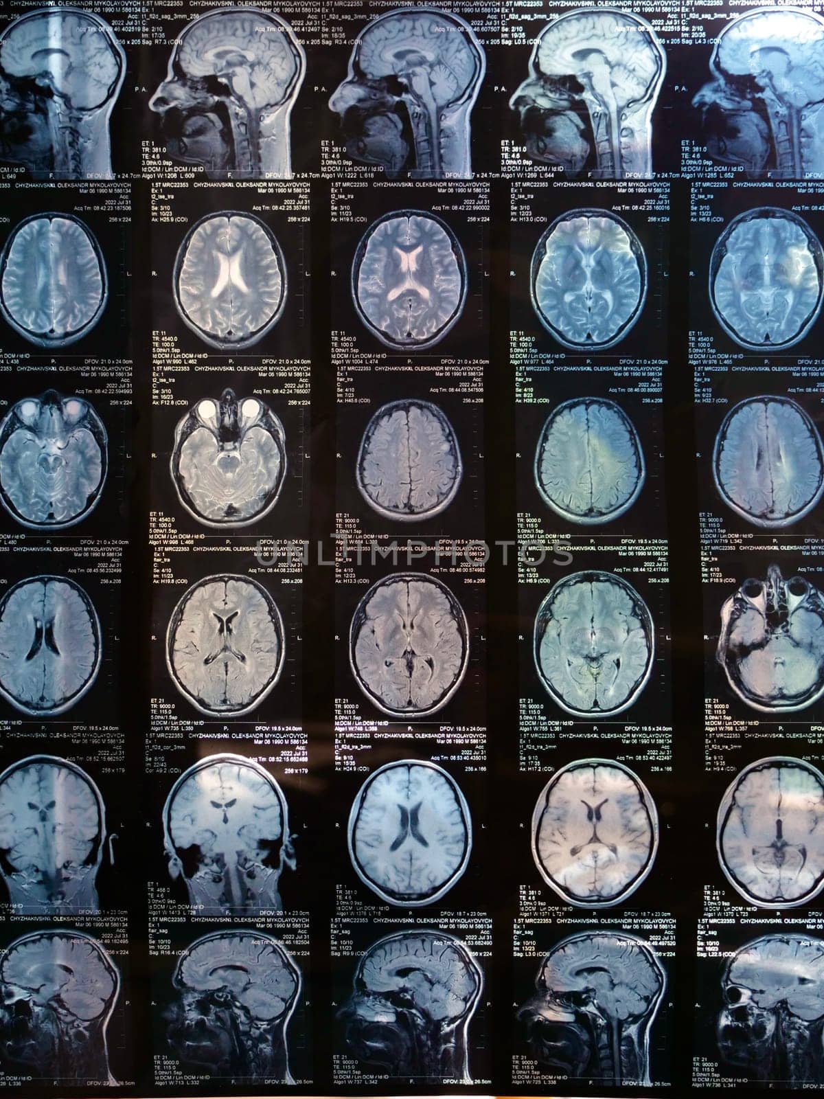 MRI of the human brain of a patient with multiple sclerosis of the initial stage. Close-up X-ray vertical