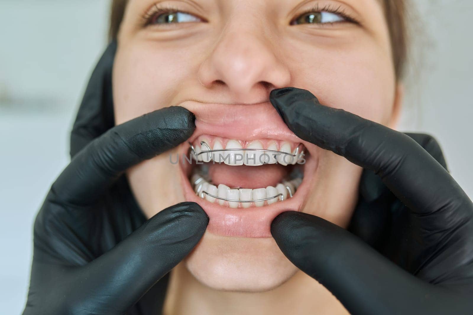 Close-up of face of teen girl with open mouth, teeth with metal orthodontic plate, hands of orthodontic doctor in medical gloves showing her teeth. Treatment dental care orthodontics dentistry health