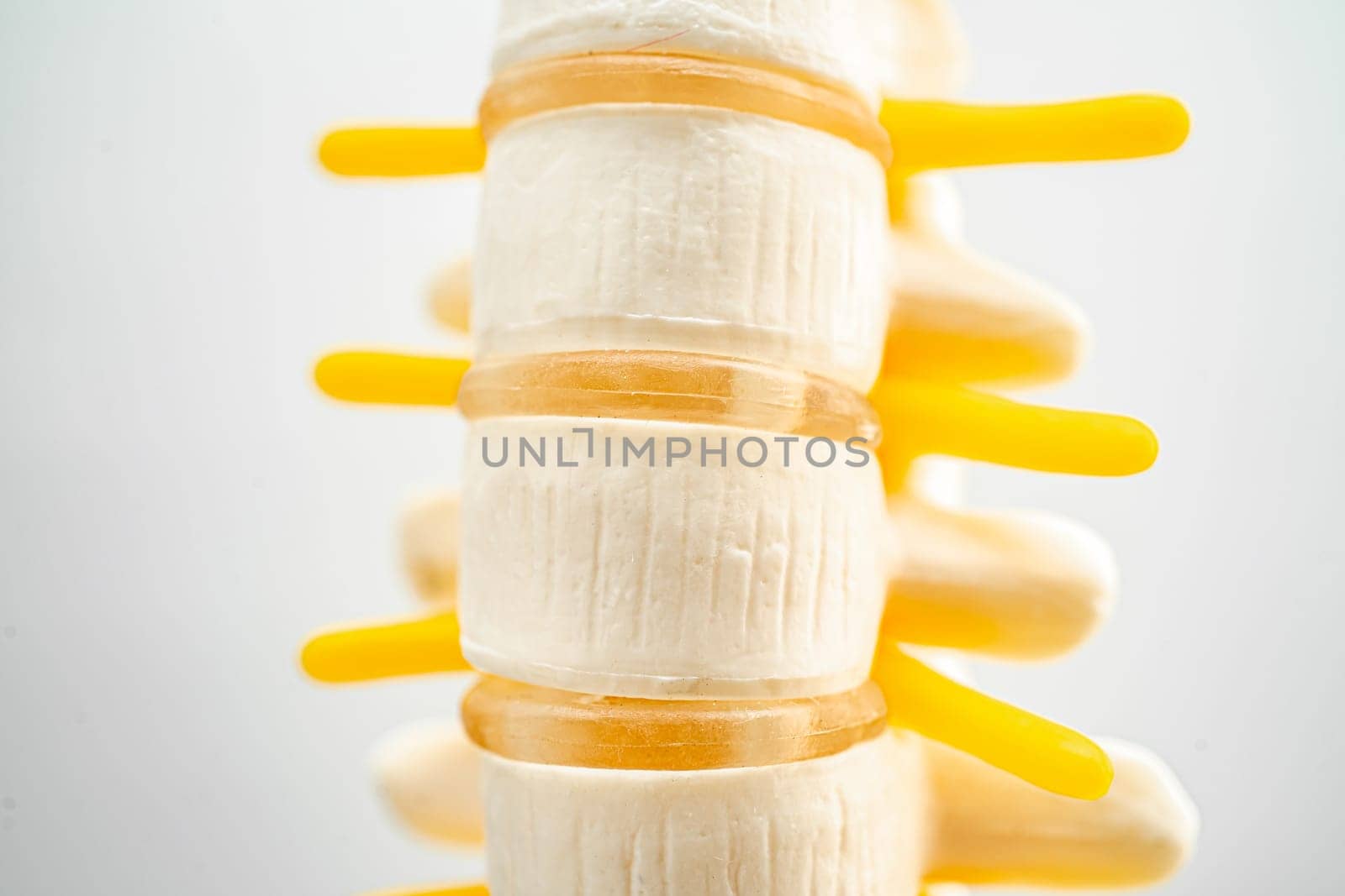 Lumbar spine displaced herniated disc fragment, spinal nerve and bone. Model for treatment medical in the orthopedic department. by pamai
