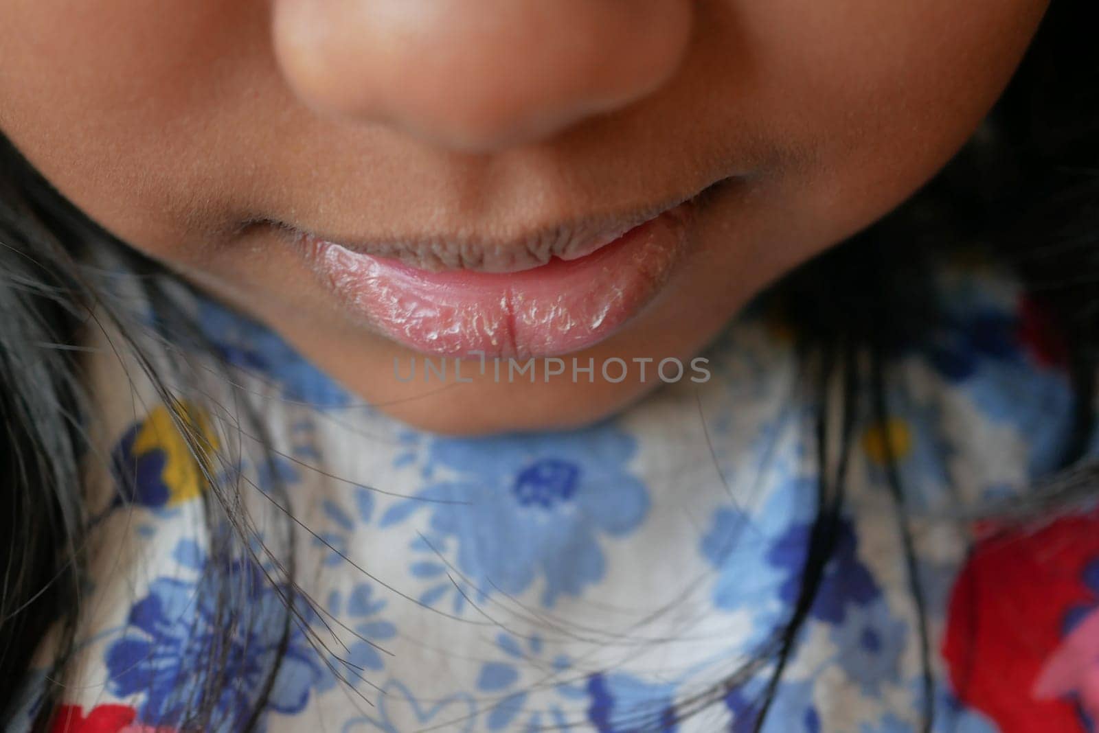 close up of dry lip of a child by towfiq007