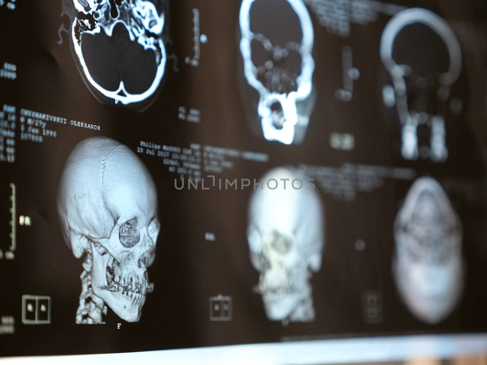 MRI of the human brain of a patient with multiple sclerosis of the initial stage. Close-up X-ray