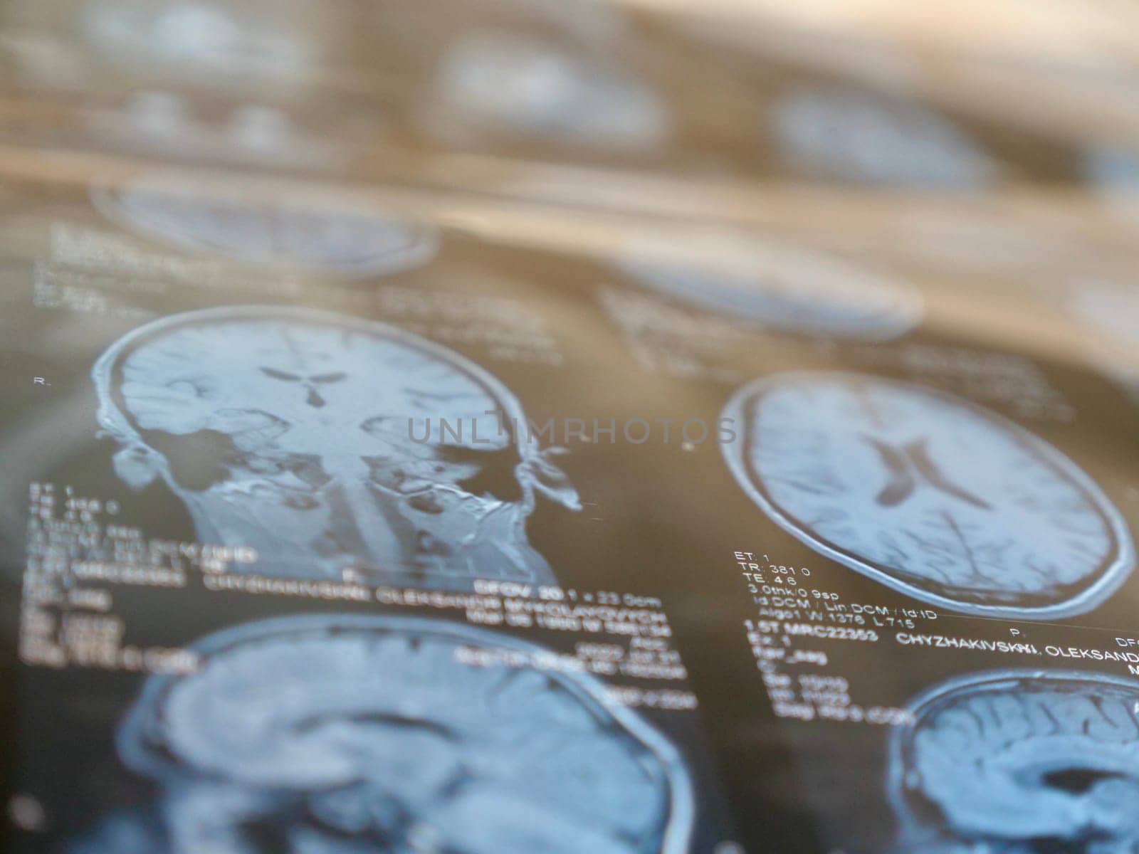 MRI of the human brain of a patient with multiple sclerosis of the initial stage. Close-up X-ray