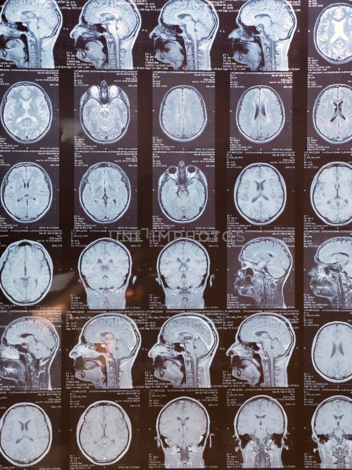 MRI of the human brain of a patient with multiple sclerosis of the initial stage. Close-up X-ray vertical