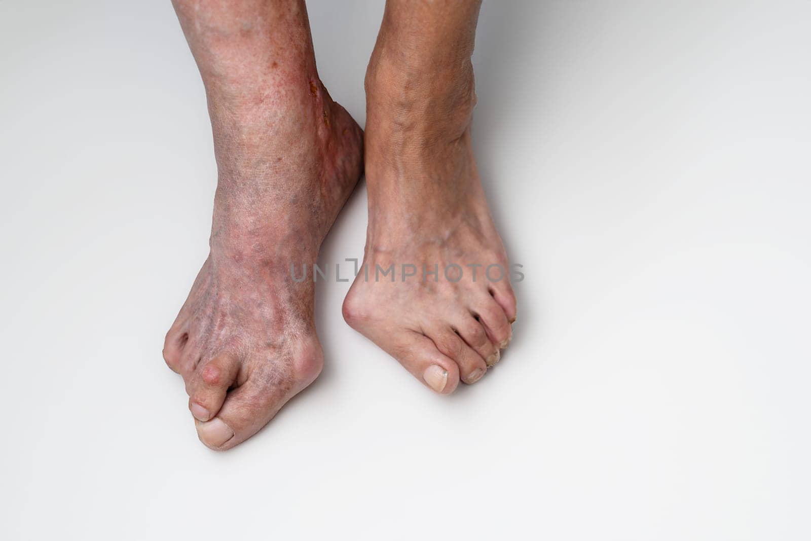 Overhead shot captures feet of senior woman, showing visible effects of bunion and hallux valgus on white background, deformity of MTP joint connecting big toe to foot
