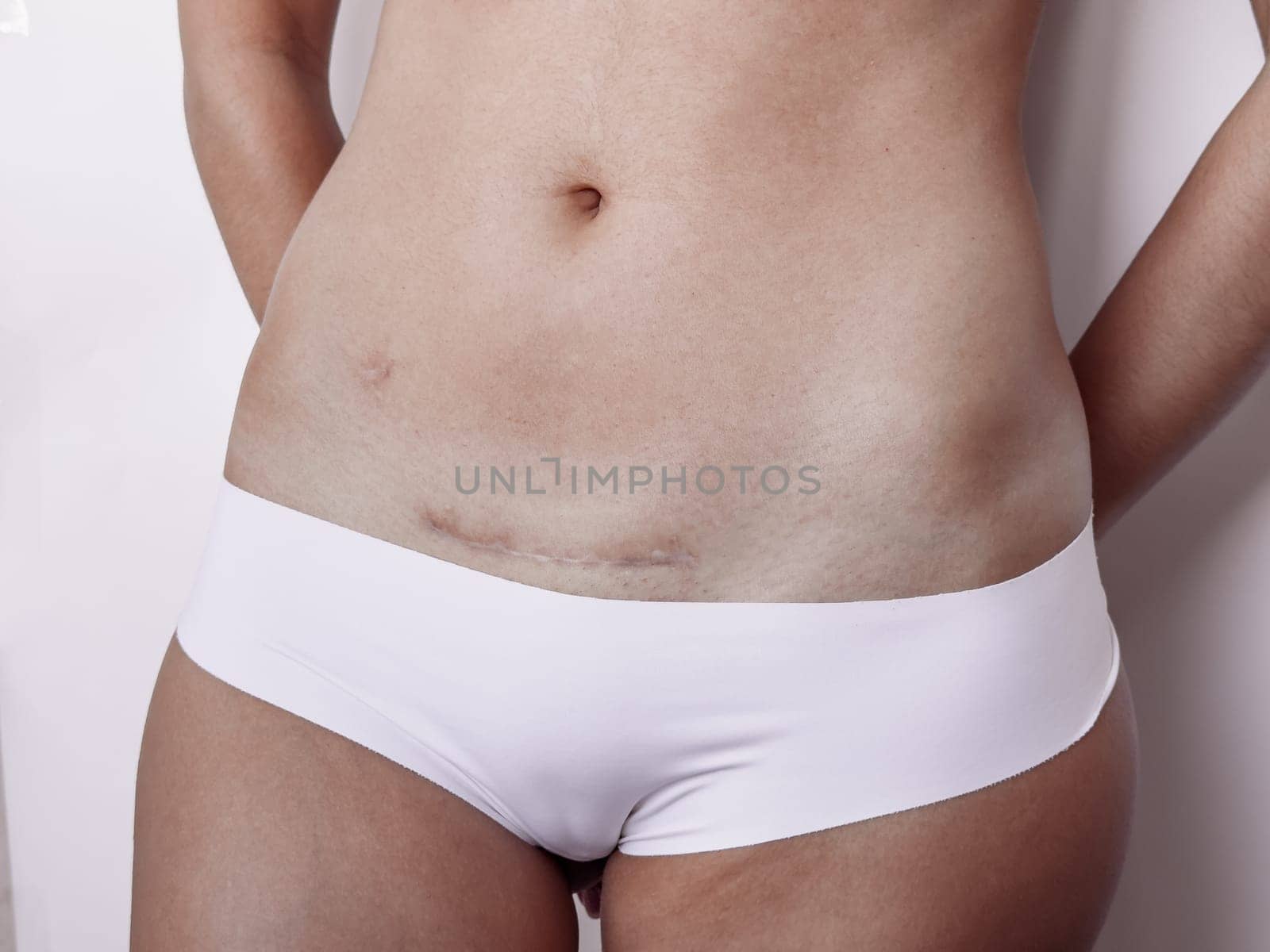 C section scar on female abdomen. Healing, recovery, and strength.