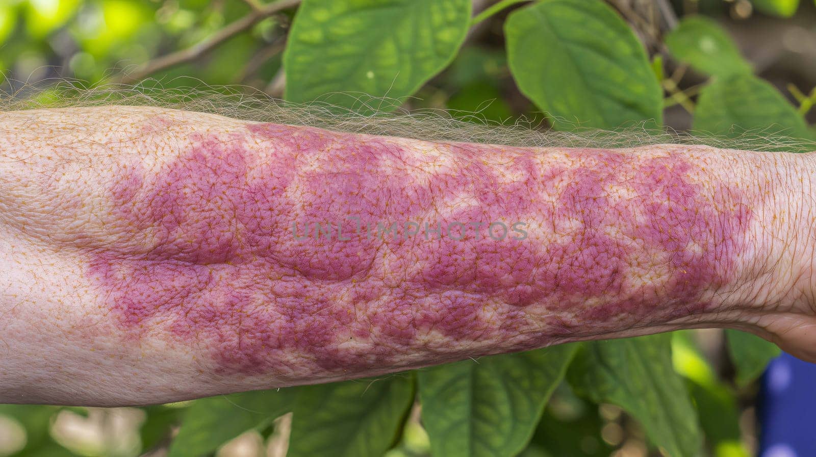 Arm with a large area of skin showing red splotches and discoloration