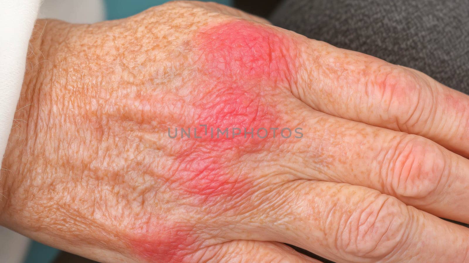 Close-up of senior woman hand showing symptoms of psoriasis, red, flaky skin