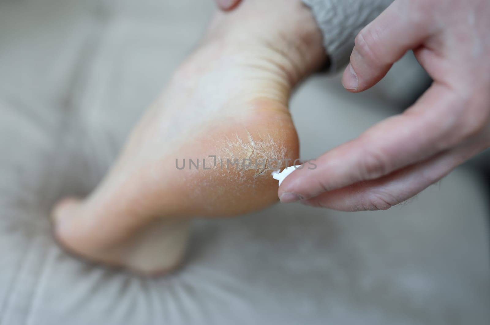 Close-up of person applying smoothing cream on damaged and problem areas on skin. Barefoot man with unhealthy and unattractive heel. Effect of uncomfortable shoes