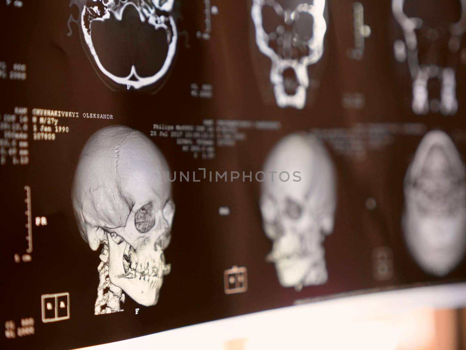 MRI of the human brain of a patient with multiple sclerosis of the initial stage. Close-up X-ray