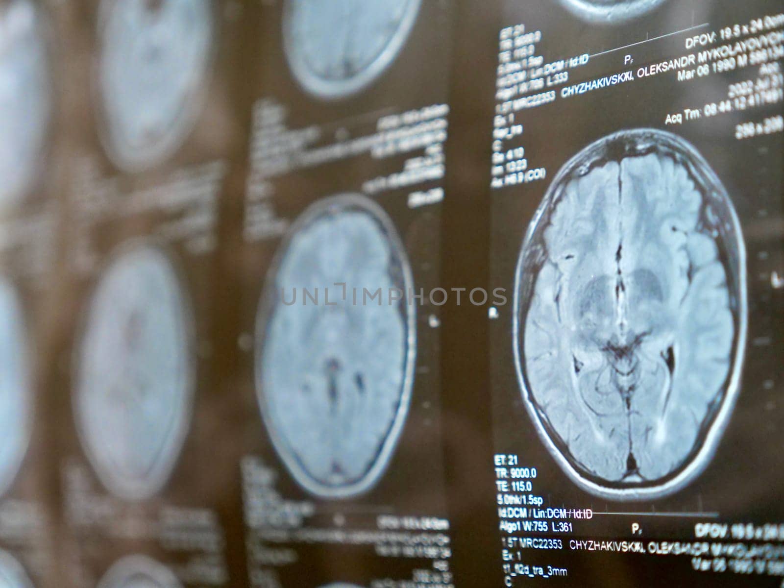 MRI of the human brain of a patient with multiple sclerosis of the initial stage. Close-up X-ray