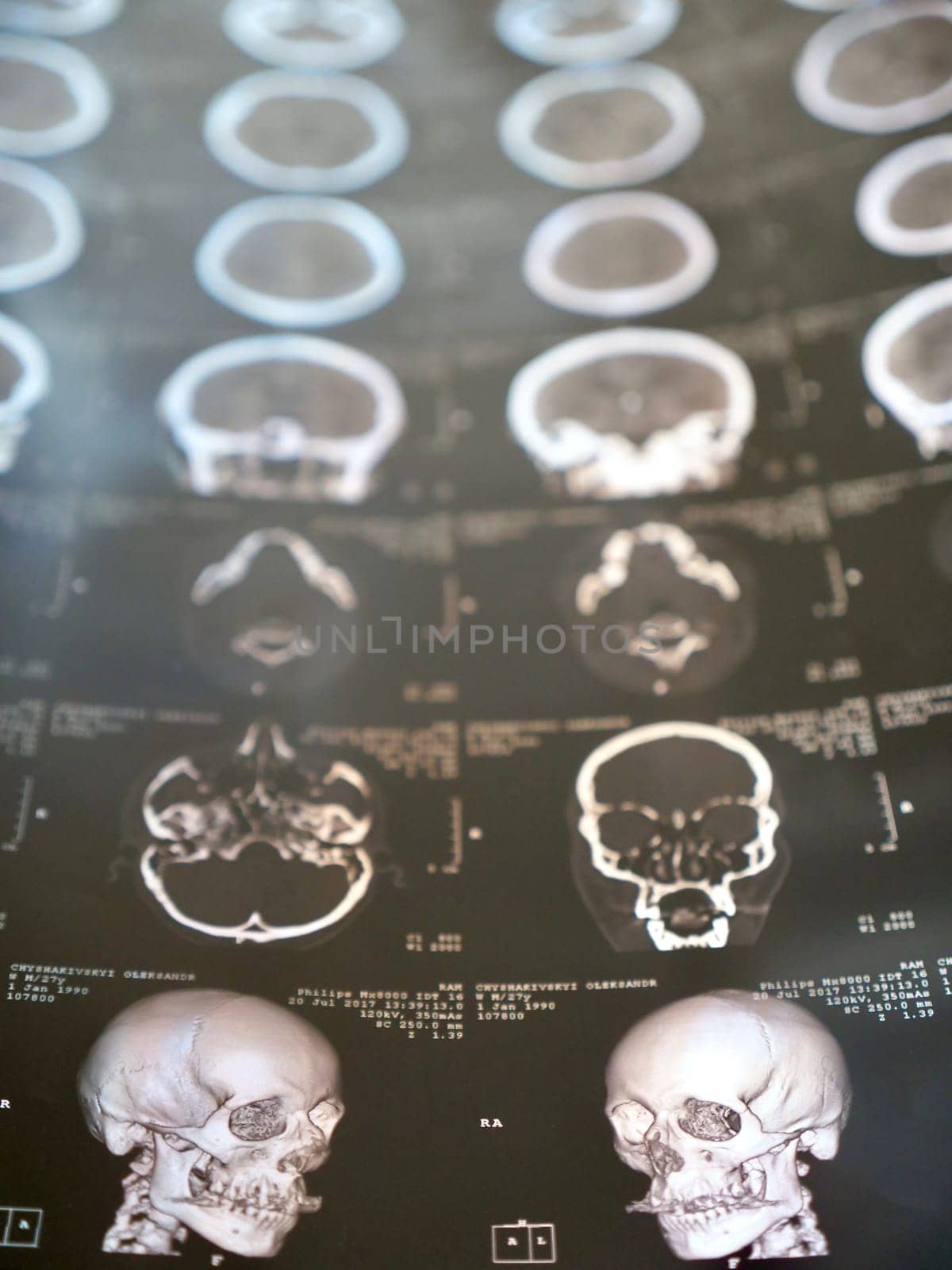 MRI of the human brain of a patient with multiple sclerosis of the initial stage. Close-up X-ray vertical