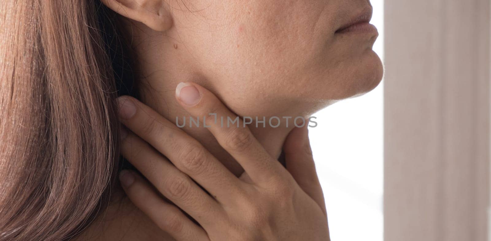 Cervical lymphadenitis of the right side in a woman