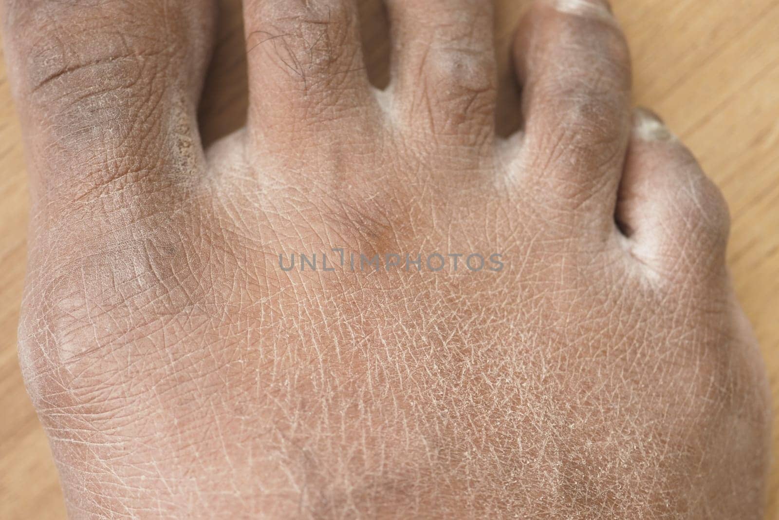 Closeup view of dry human skin