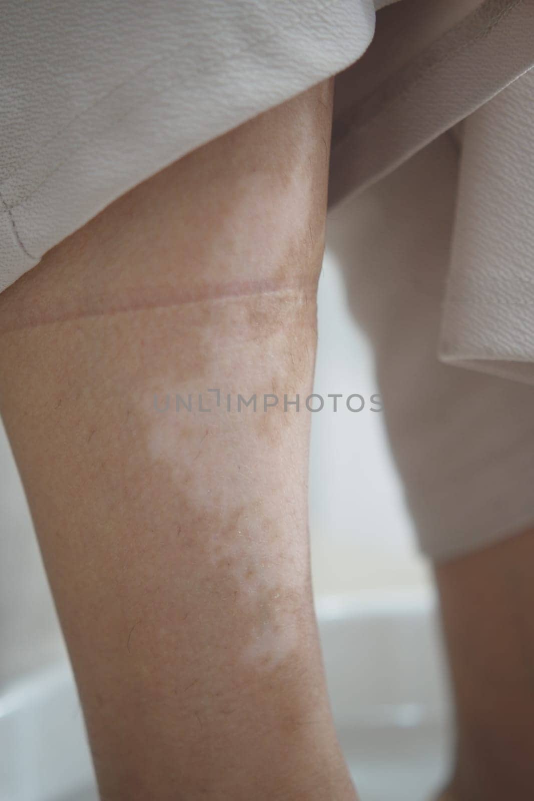 feet with vitiligo skin condition