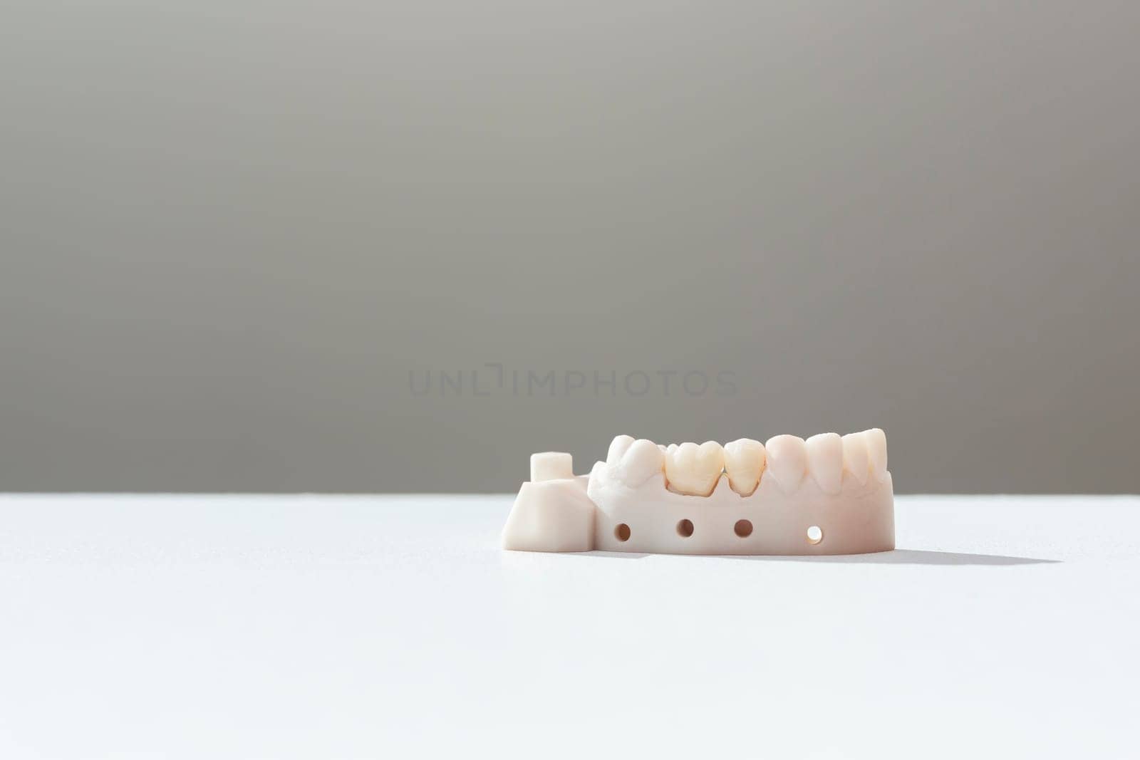 Teeth Crowns And Bridge Equipment Model Shows Fix Restoration, Prosthodontics Or Prosthetic. Inserting Or Placing Procedure Of Ceramic Dental Crown. Horizontal View, Space For Text. by netatsi