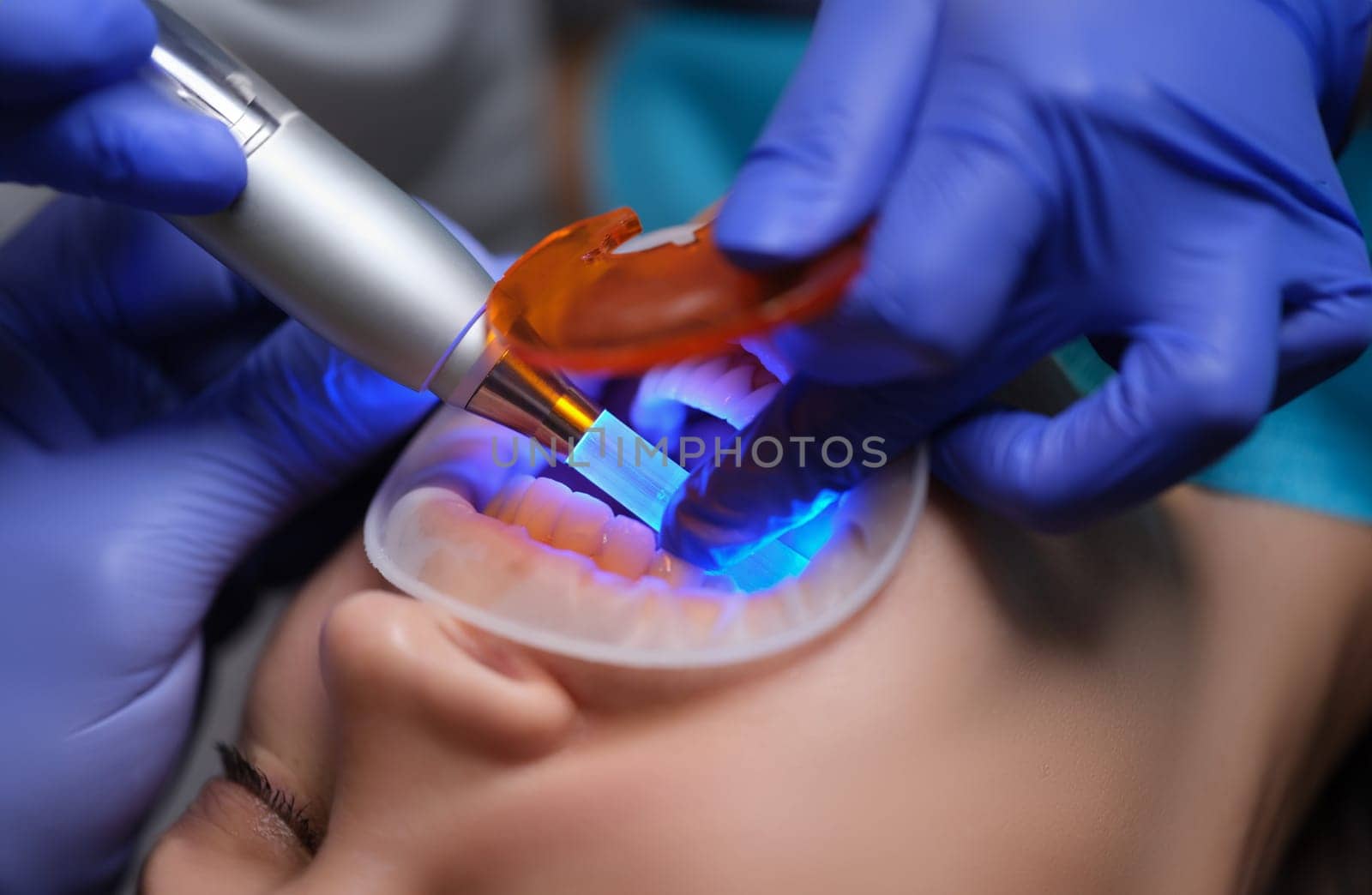 Doctor dentist illuminating filling with modern light lamp in clinic closeup by kuprevich