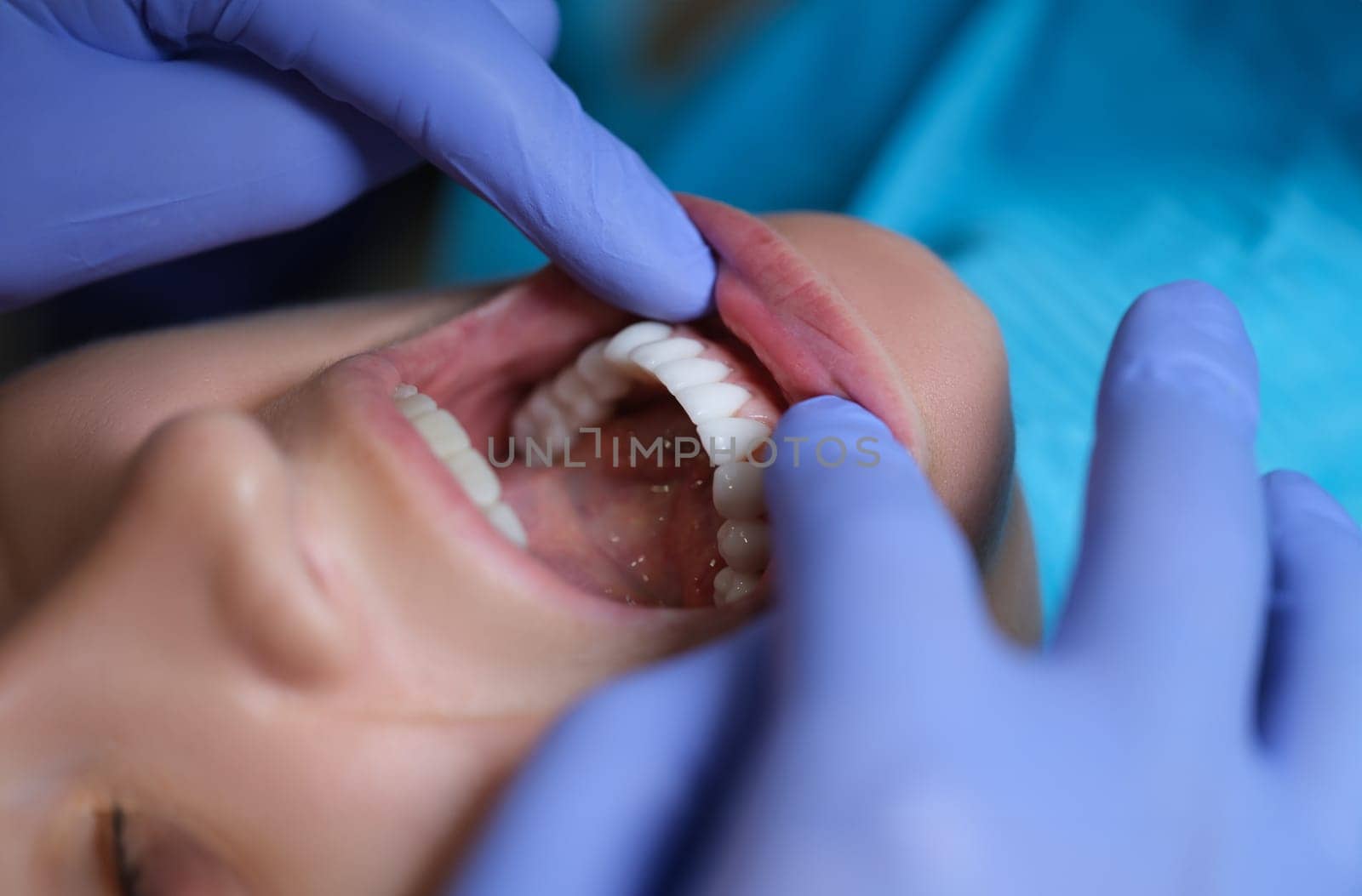 Doctor dentist examining patient oral cavity with veneers closeup. Installation of composite and zirconium veneers concept