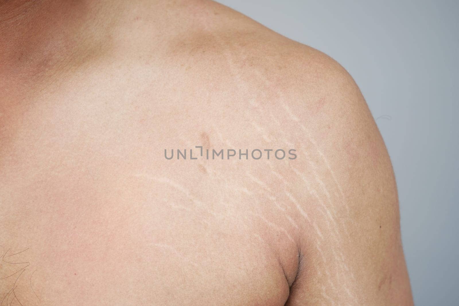Close-Up of Stretch Marks on Human Skin for Medical and Cosmetic Purposes.