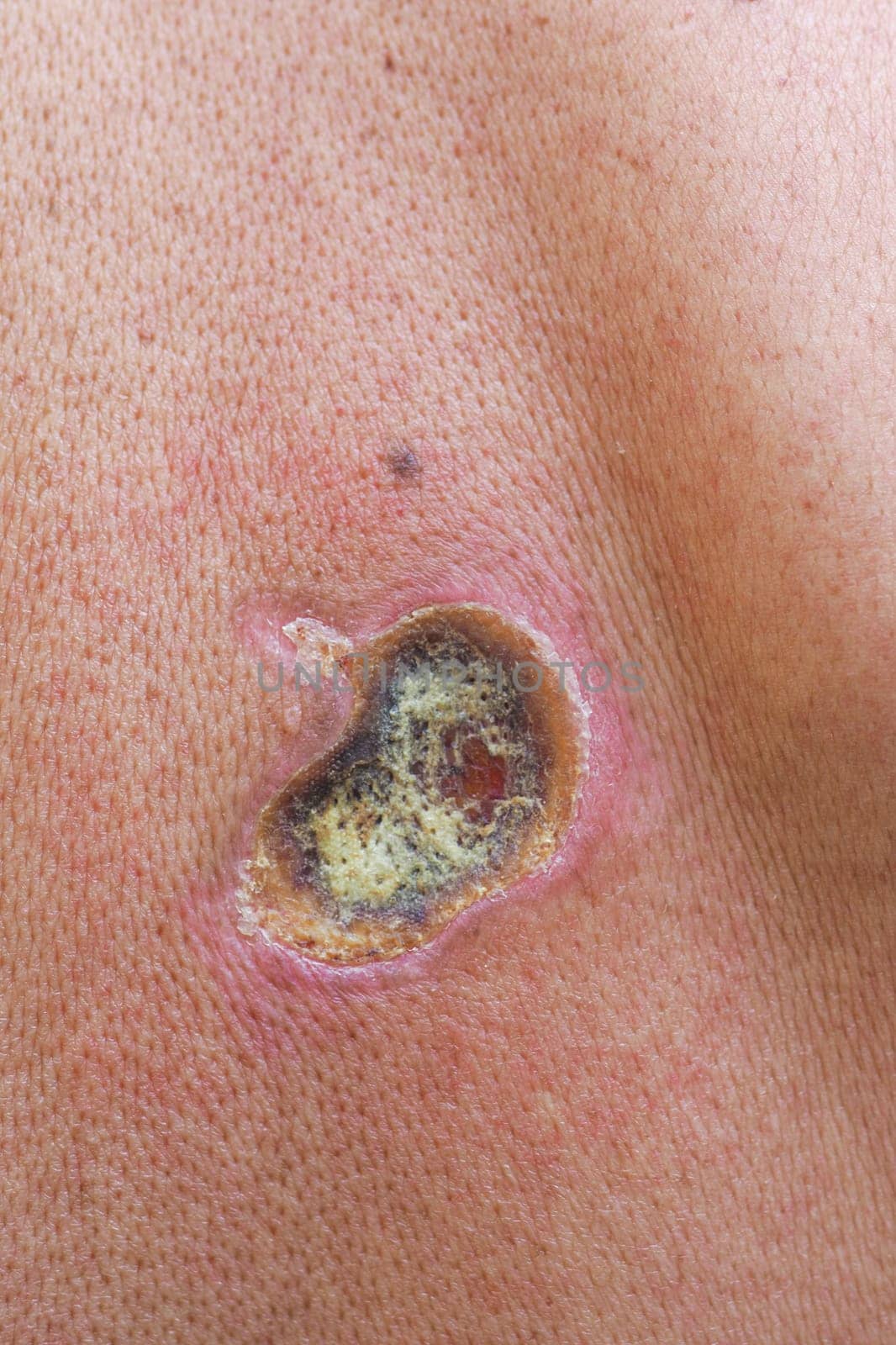 Electric current passing through body causes skin lesion with entry and exit wounds on adult caucasian man, highlighting healthcare and safety concerns