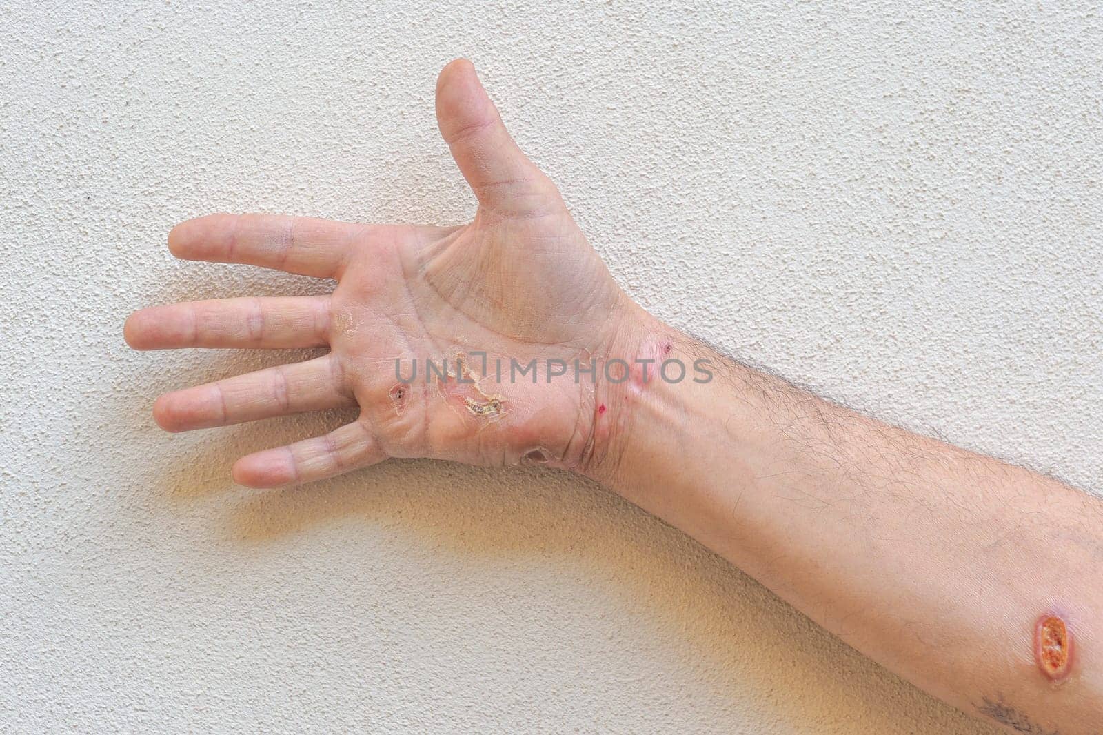 Entry and exit wounds of an electrical burn are visible on caucasian man's hand and arm, highlighting the severity of electrical injuries and the importance of safety precautions