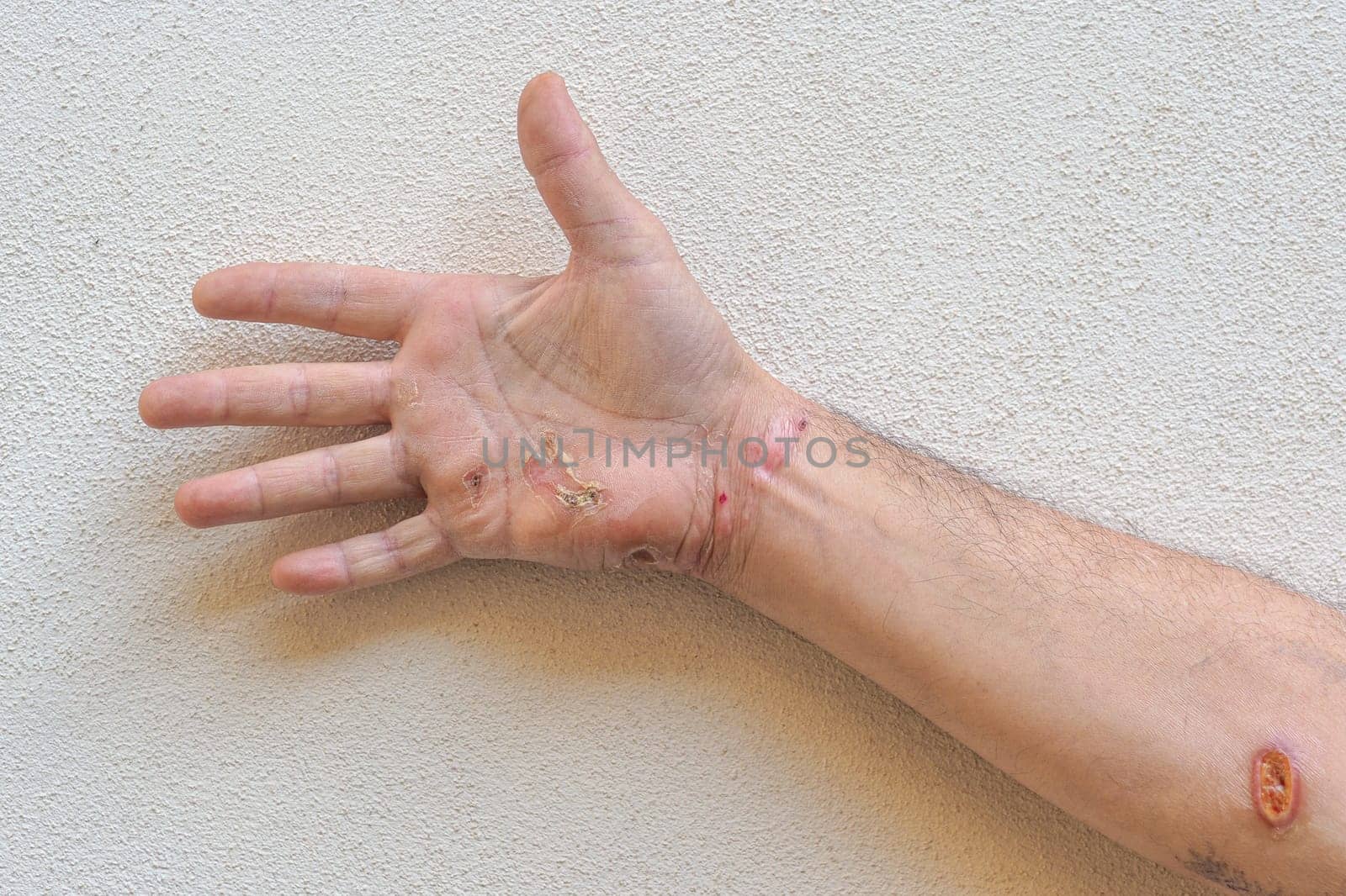 Entry and exit wounds of an electrical burn are visible on a caucasian man's hand and arm, highlighting the severity and impact of electrical shocks on human skin