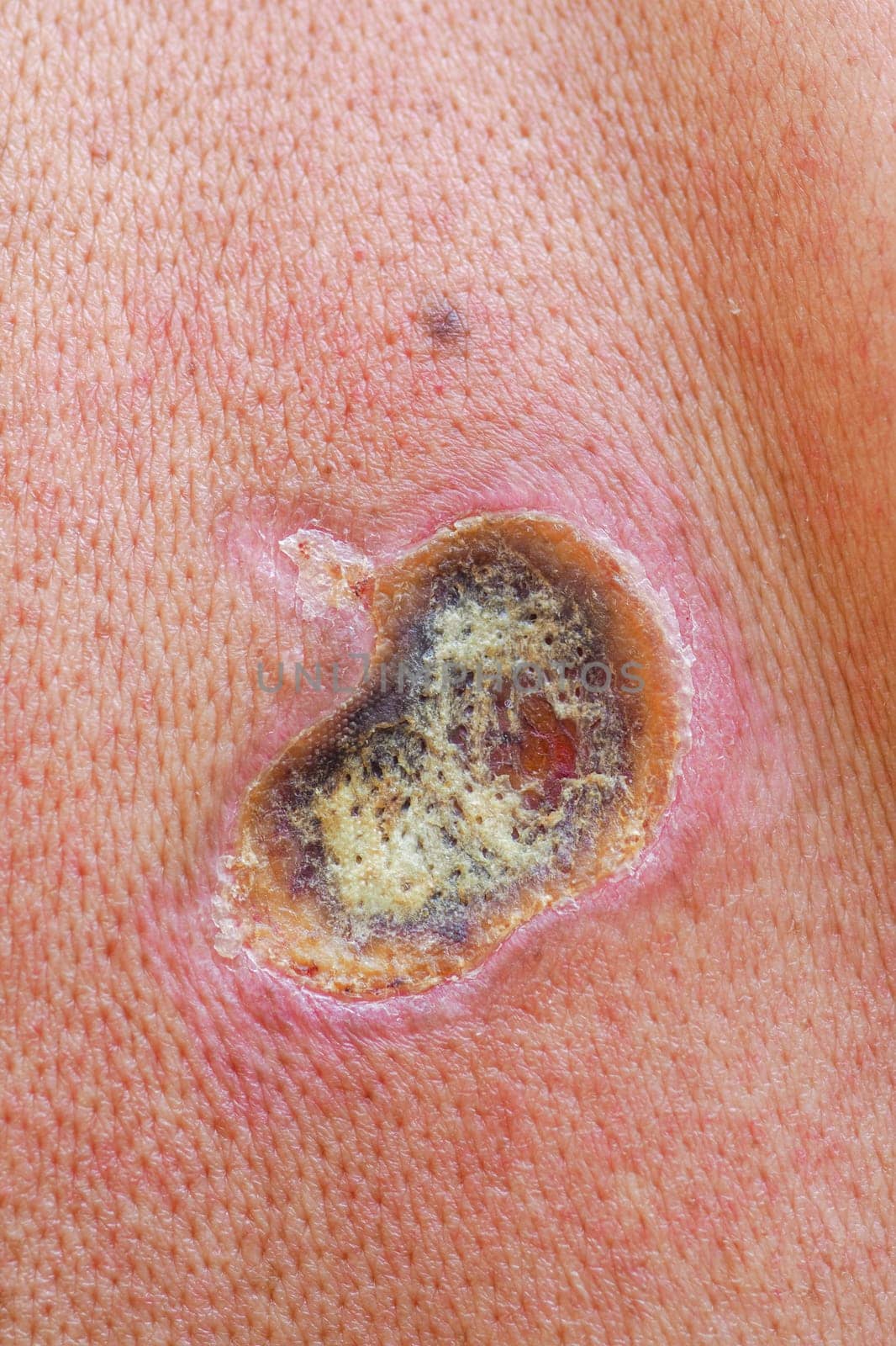 Electric current passing through body tissue causes a third-degree burn wound with skin entry and exit point, highlighting the dangers of electricity and importance of safety precautions