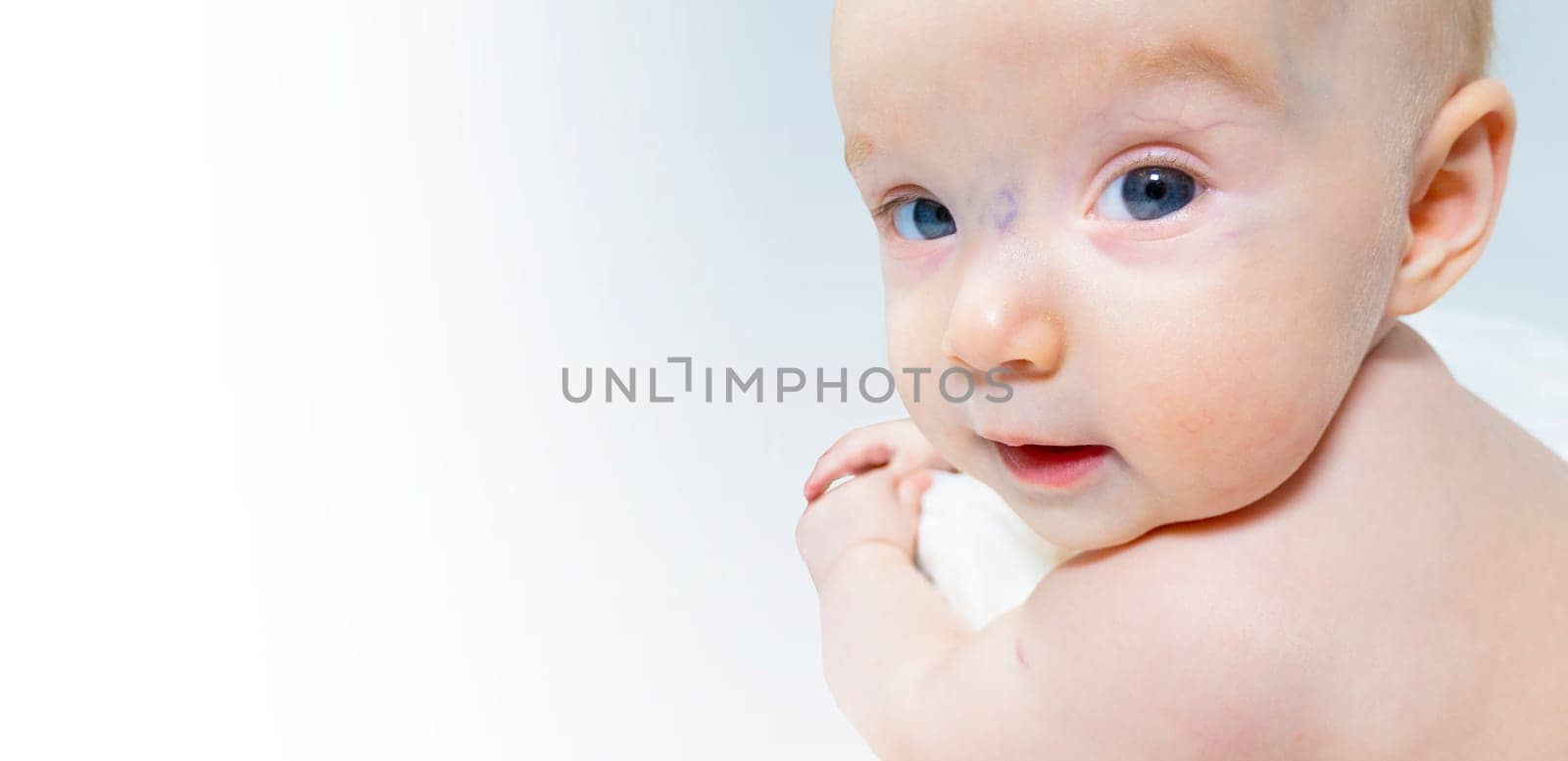 a baby with a hemangioma on his neck lies on a white background by kajasja