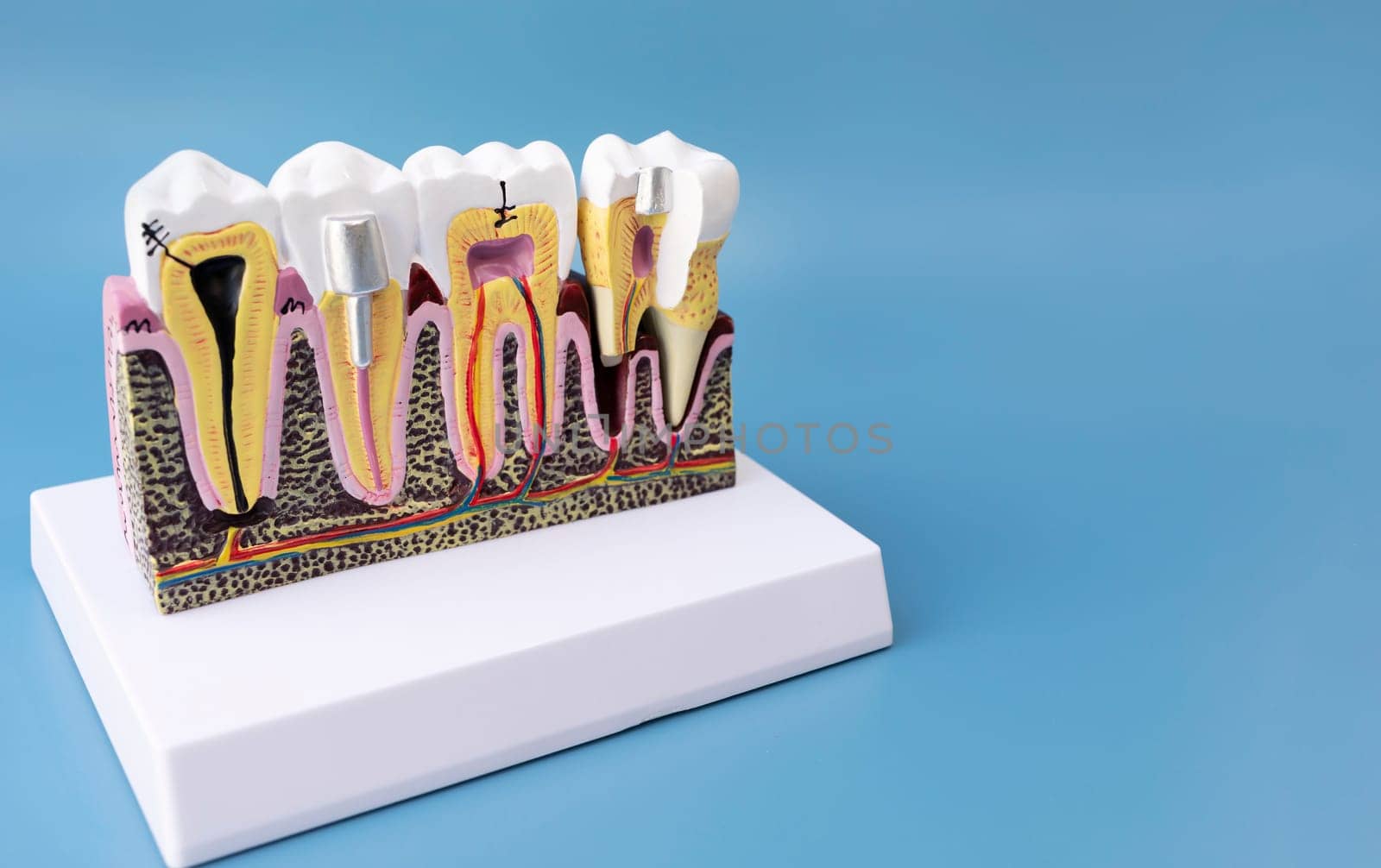 Dental Tooth Bridge Or Implant Model On Blue Background, Copy Space For Text. Dummy Mockup Human Jaw Oral Dentures. Prosthesis On Metal Peg. Horizontal Plane. High quality photo