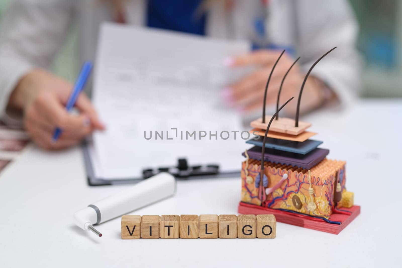 A detailed skin model showcasing the distinct effects of vitiligo and emphasizing its unique clinical features