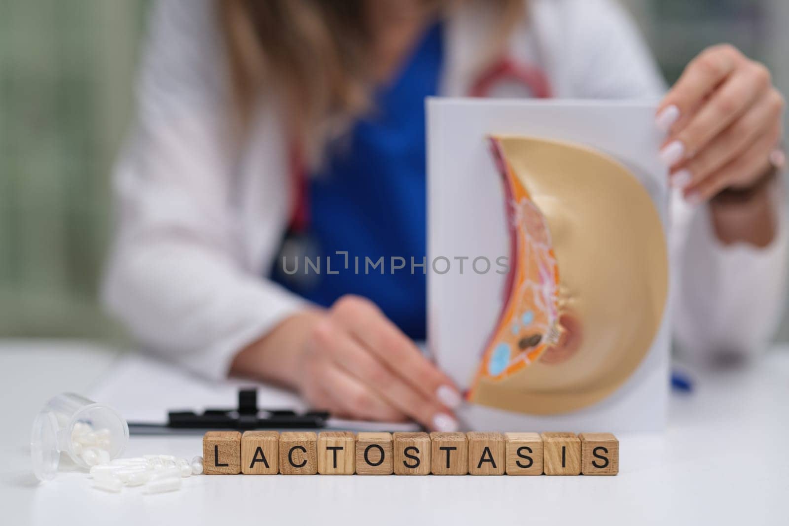 A thorough and detailed representation of lactostasis, which is a crucial concept in raising breastfeeding awareness