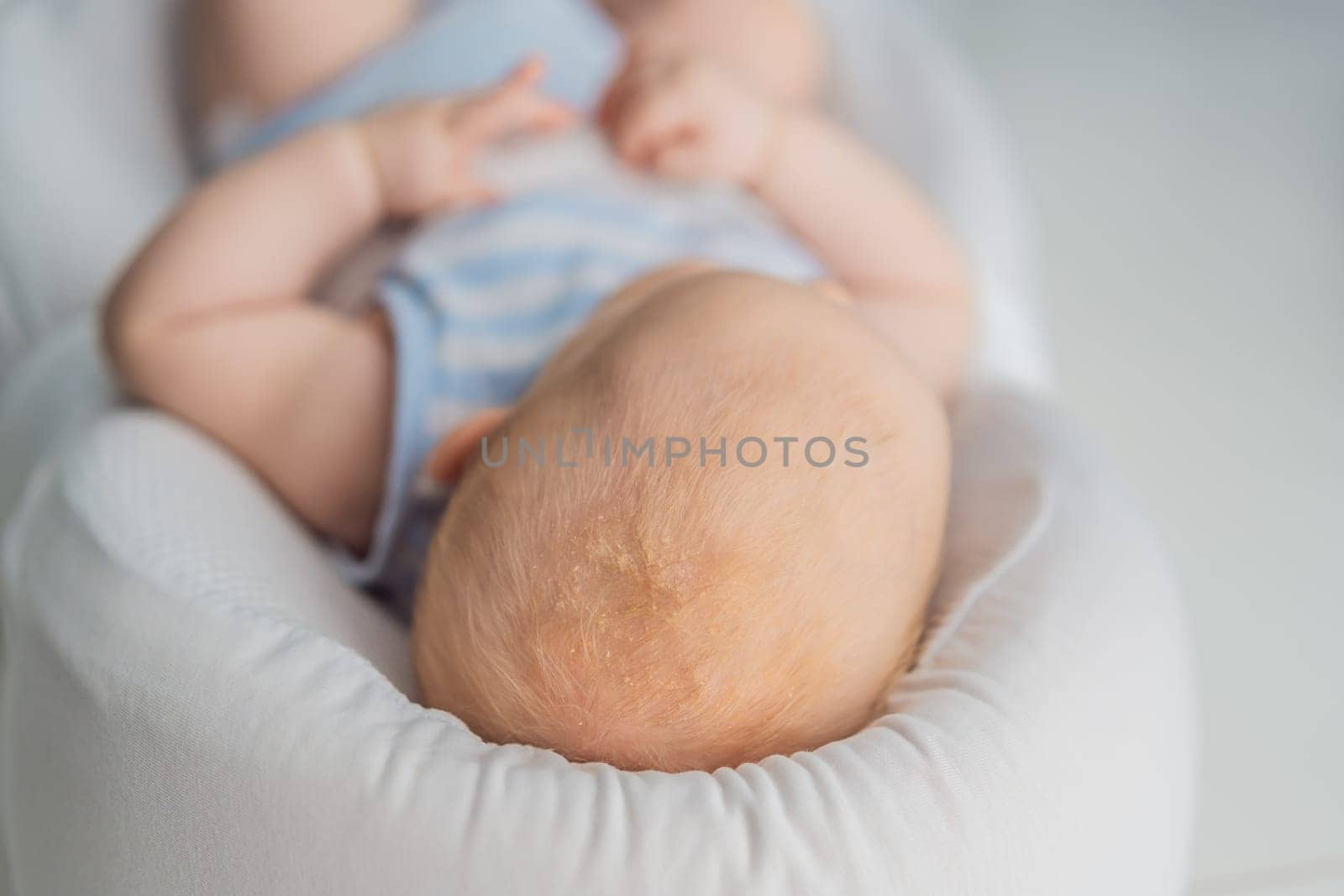 Close-up of a baby scalp showing cradle cap seborrheic dermatitis with dry, flaky patches. Common skin condition in newborns. Infant care, skincare, and health awareness concept.