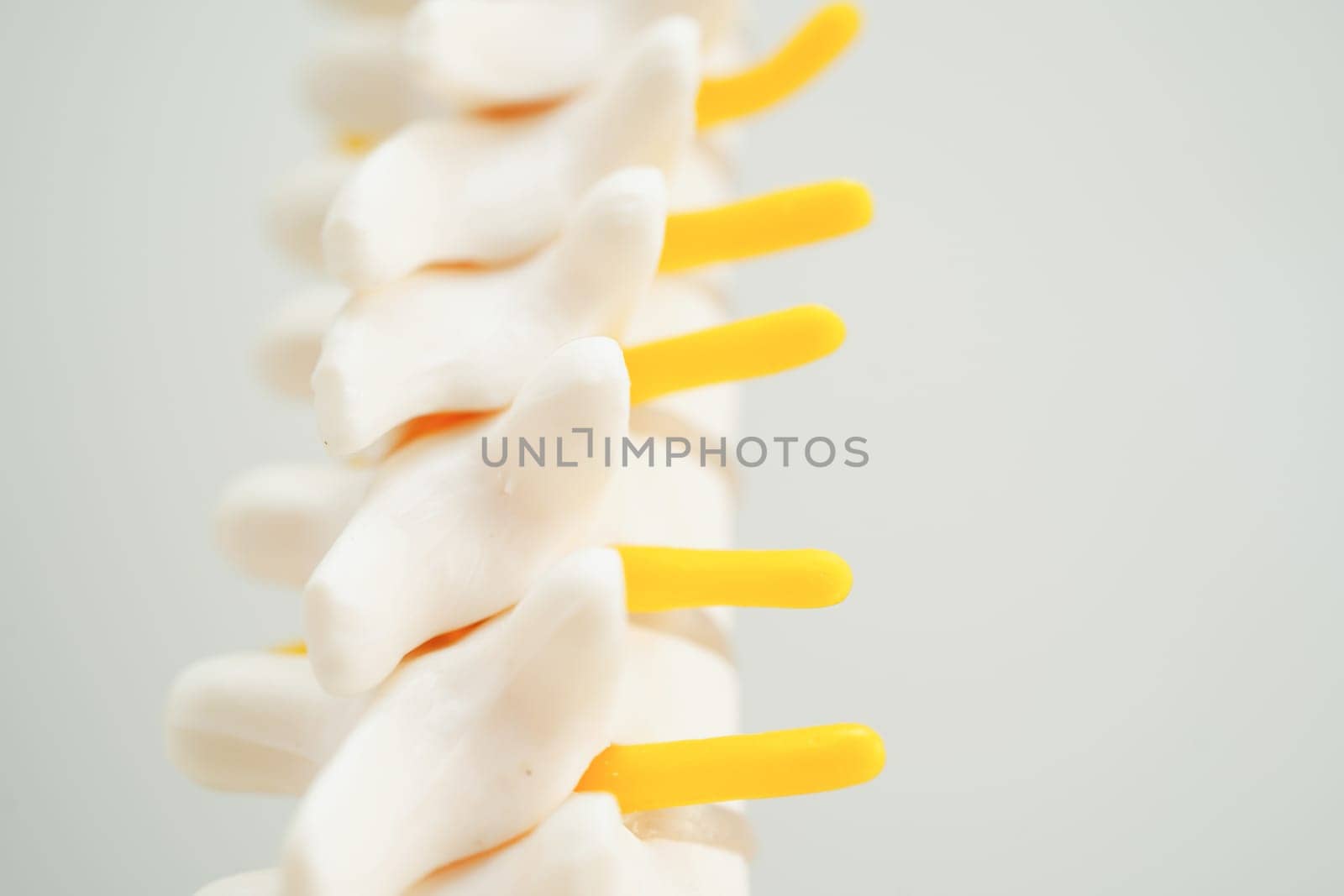 Spinal nerve and bone, Lumbar spine displaced herniated disc fragment, Model for treatment medical in the orthopedic department.