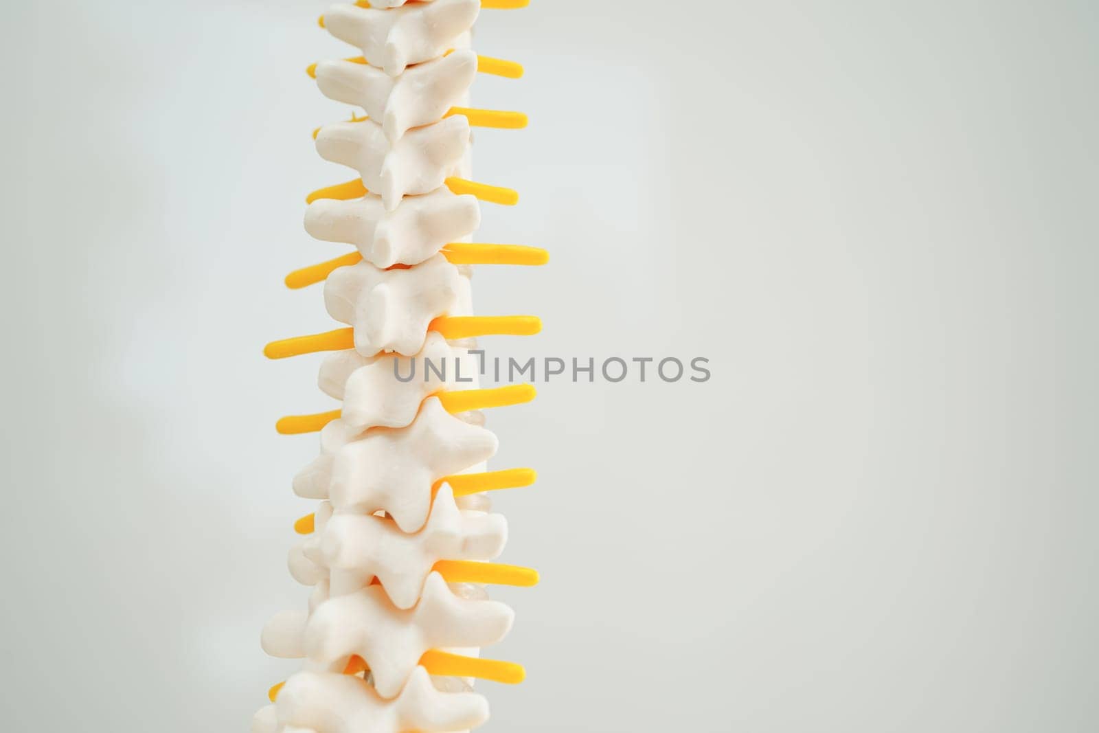 Spinal nerve and bone, Lumbar spine displaced herniated disc fragment, Model for treatment medical in the orthopedic department.
