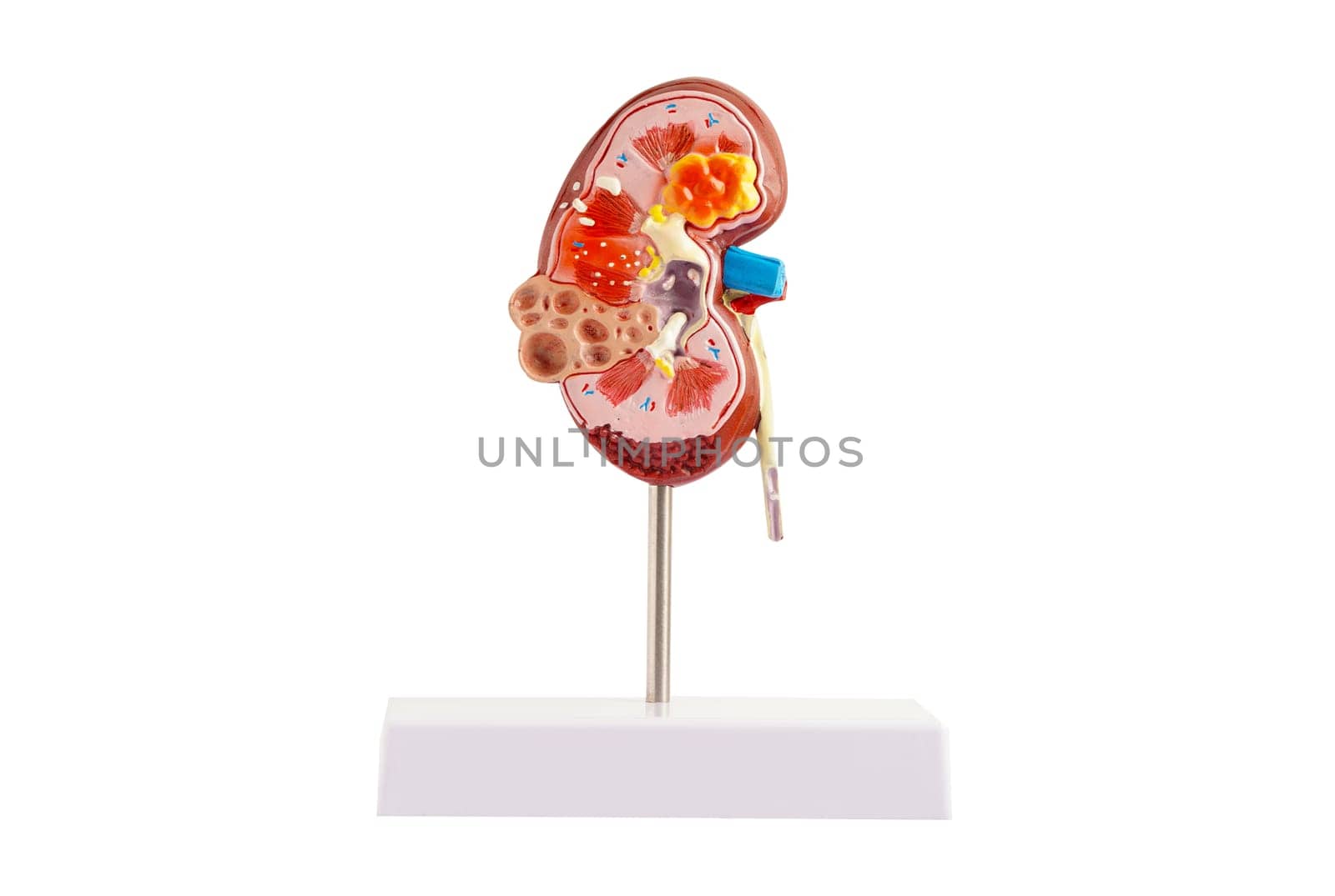 Kidney model isolated on white background with clipping path. Chronic kidney disease, treatment urinary system, urology, Estimated glomerular filtration rate eGFR.