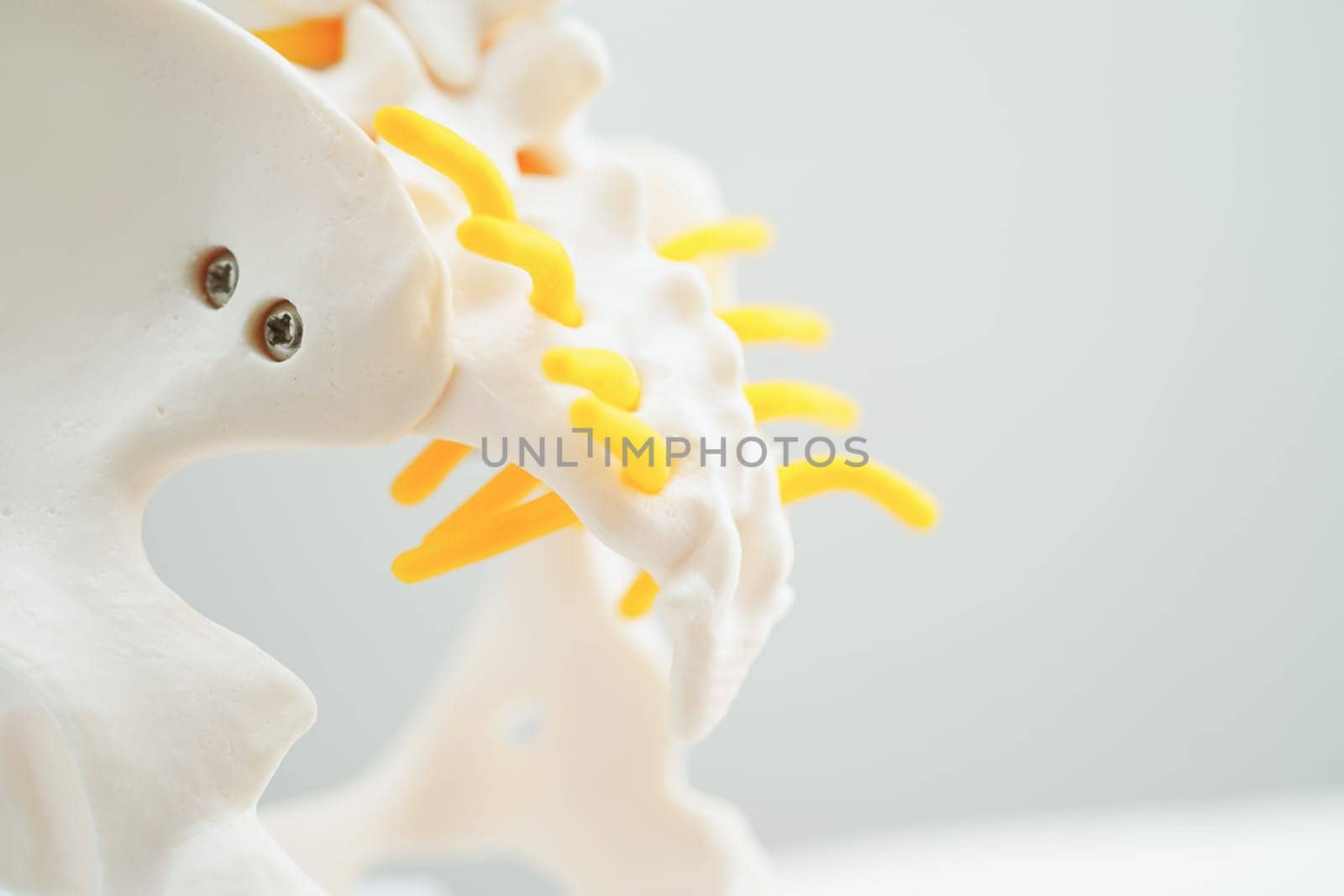 Spinal nerve and bone, Lumbar spine displaced herniated disc fragment, Model for treatment medical in the orthopedic department.