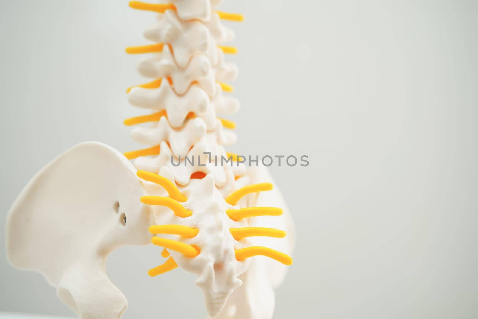 Spinal nerve and bone, Lumbar spine displaced herniated disc fragment, Model for treatment medical in the orthopedic department.