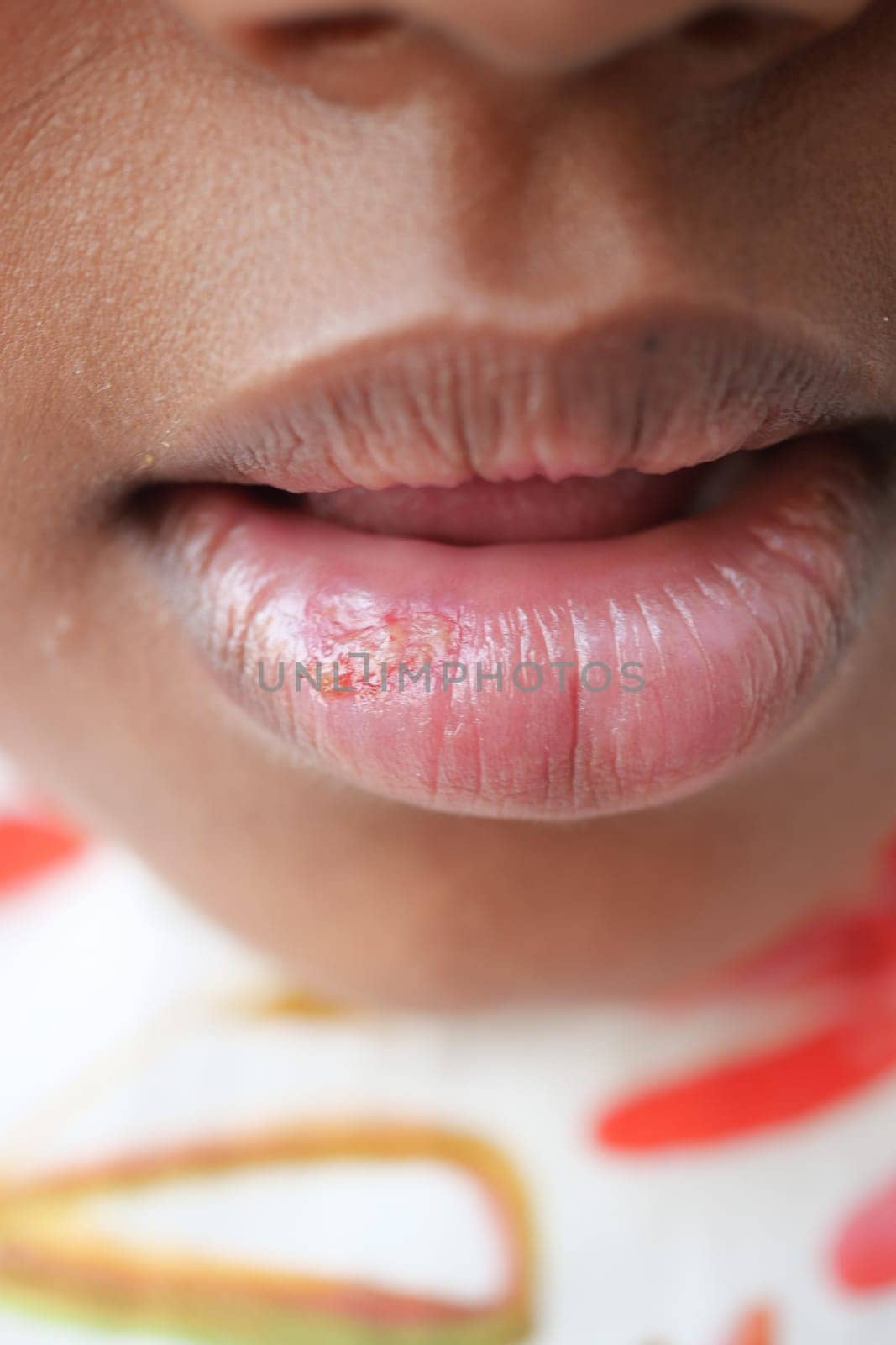close up of dry lip of a child ,