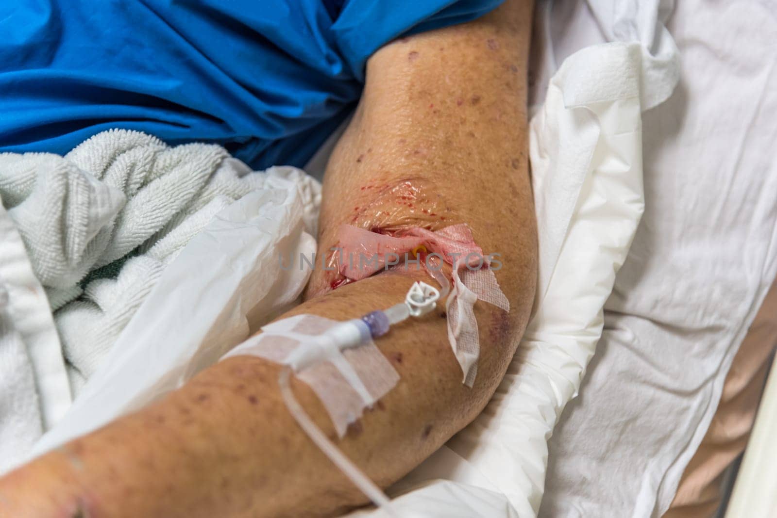 Patient in the hospital with saline intravenous on a elderly patient hand