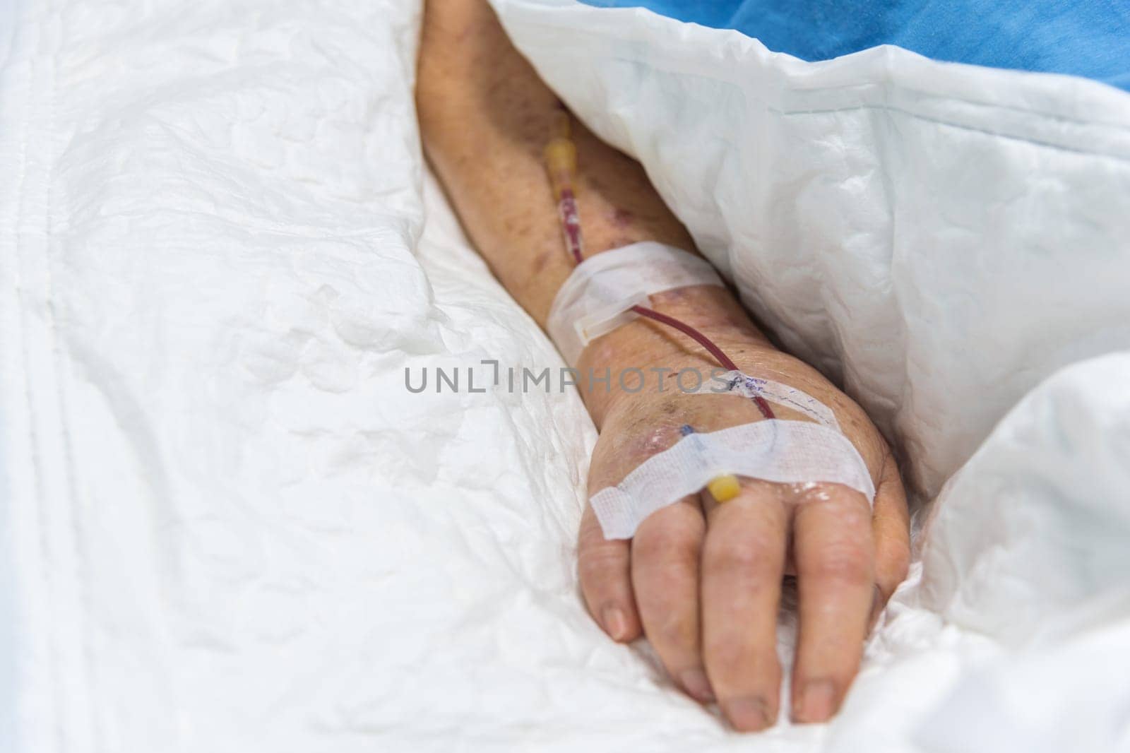 Patient asian elder women 80s with saline intravenous at C-line or A-line on a elderly patient hand on patient bed in intensive care unit (ICU.) room at hospital.