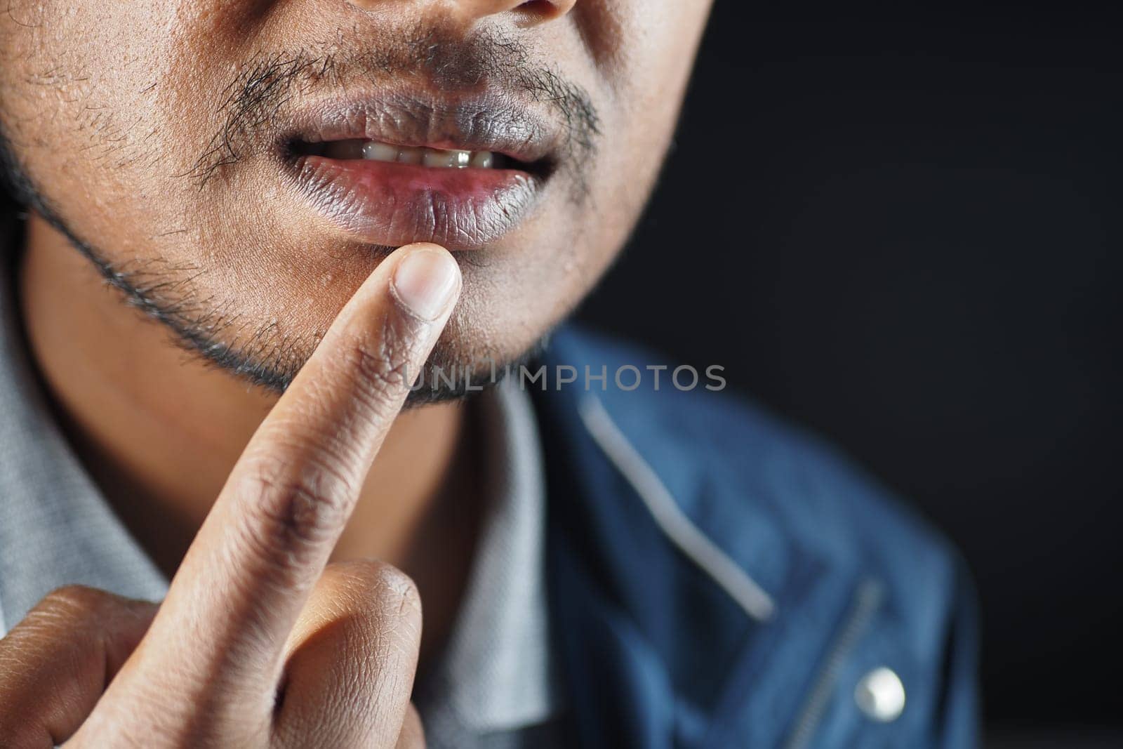 Close up of a young men hand dry lips .