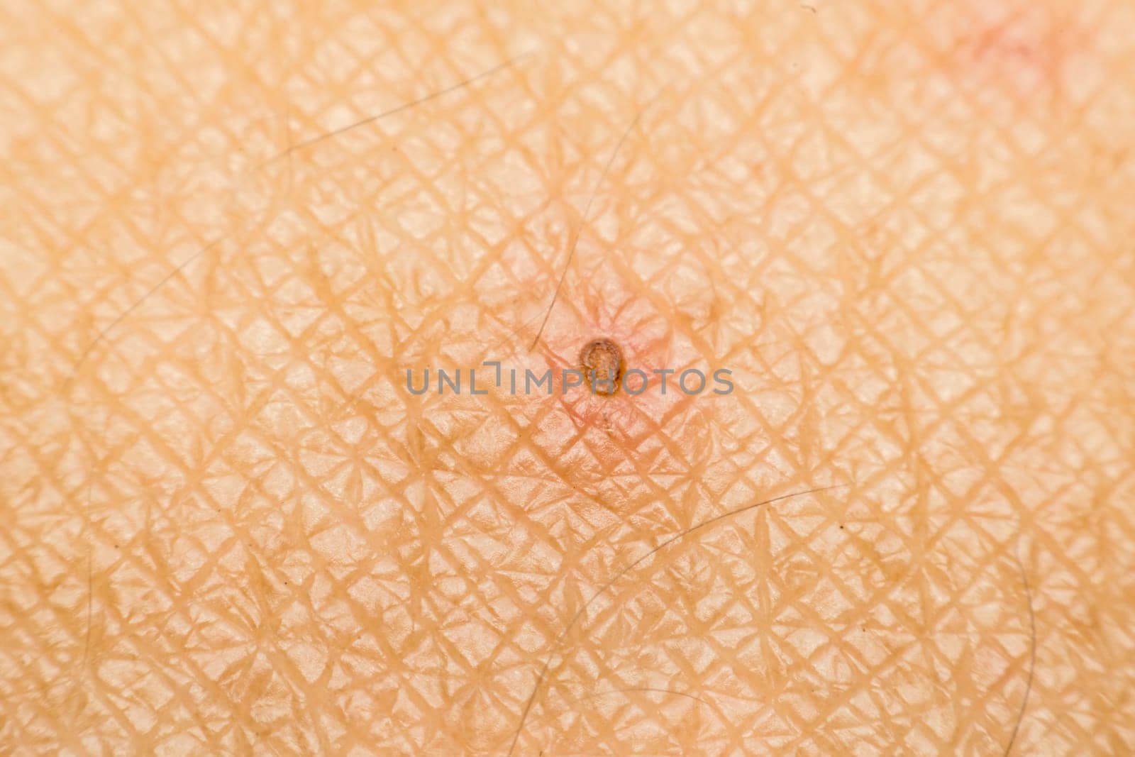 Macro of dry skin asia human with dermatology