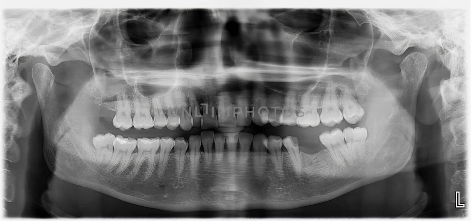 Dental panoramic X-ray of the teeth showing the structure of the teeth, with the lower molar missing