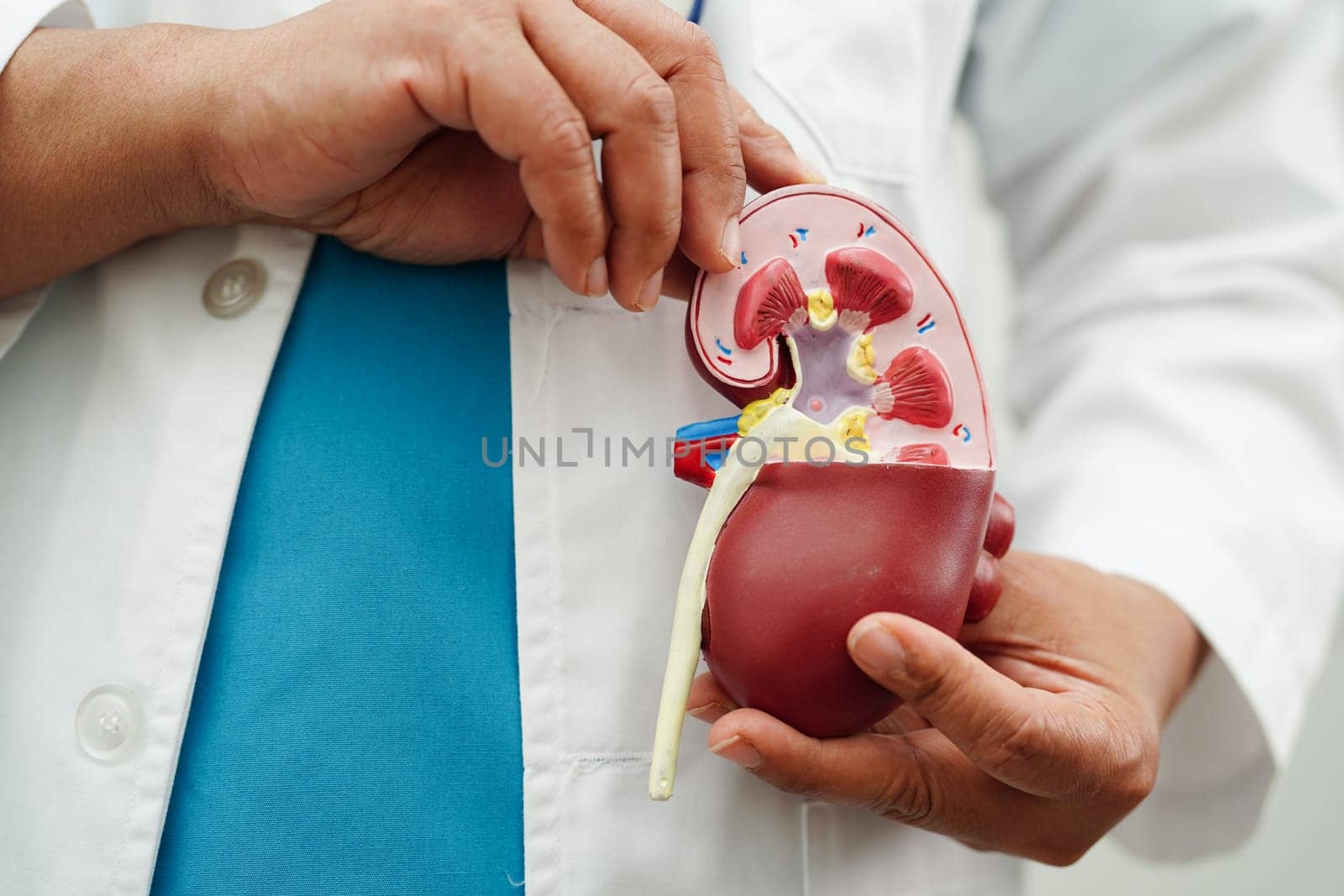 Chronic kidney disease, doctor holding model for treatment urinary system, urology, Estimated glomerular filtration rate eGFR.