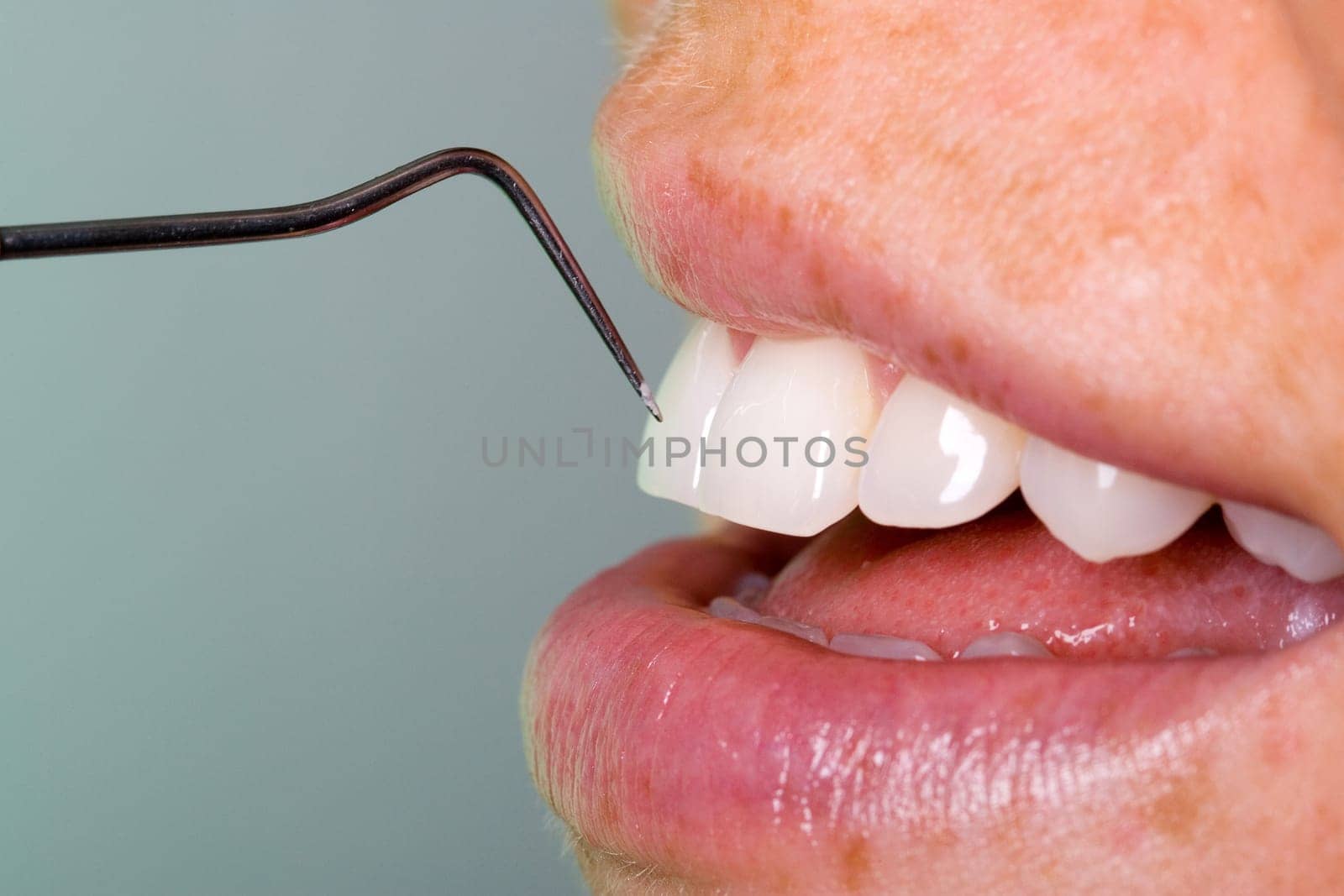 Dental check-up with probe