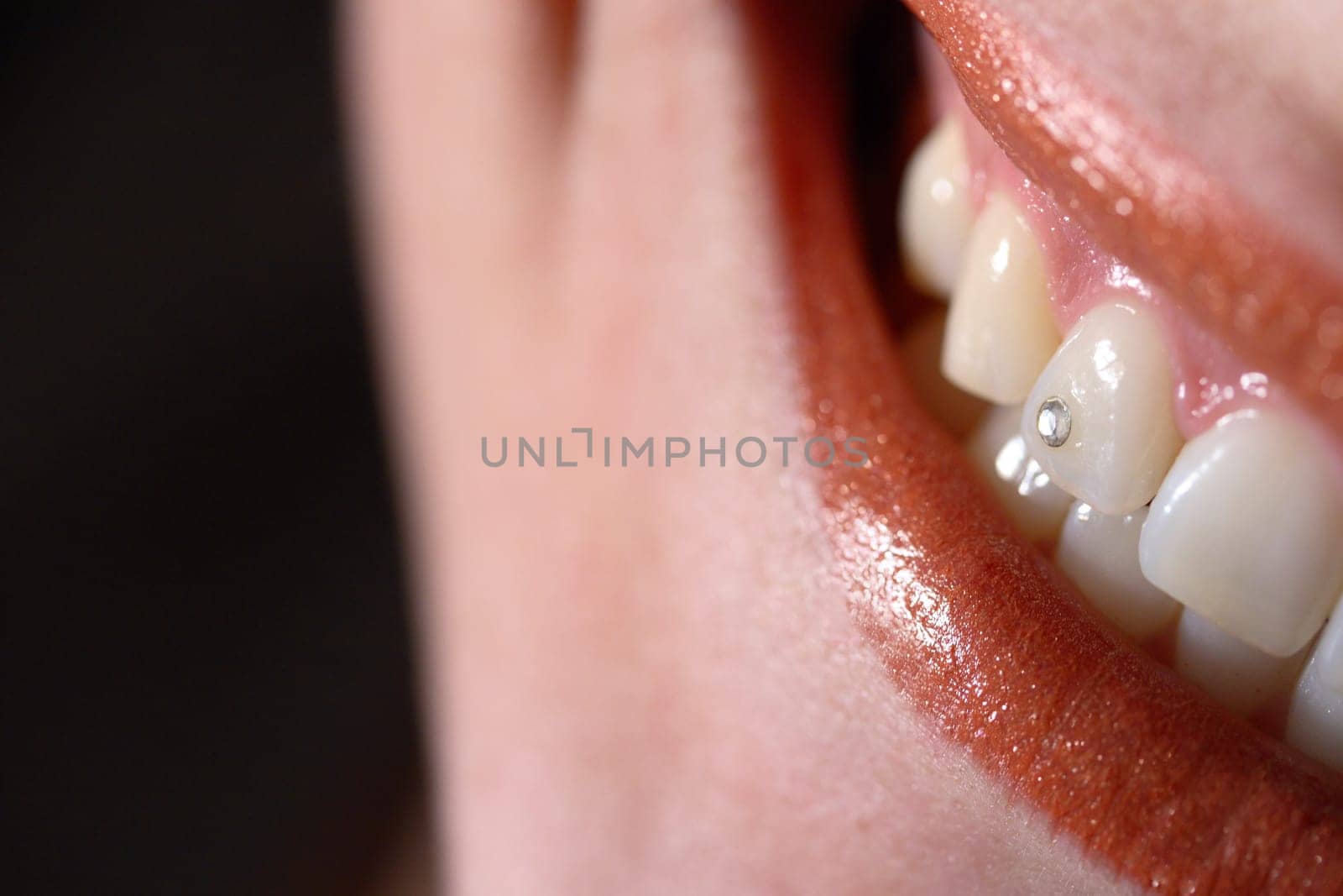 Tooth jewellery - Twinkel