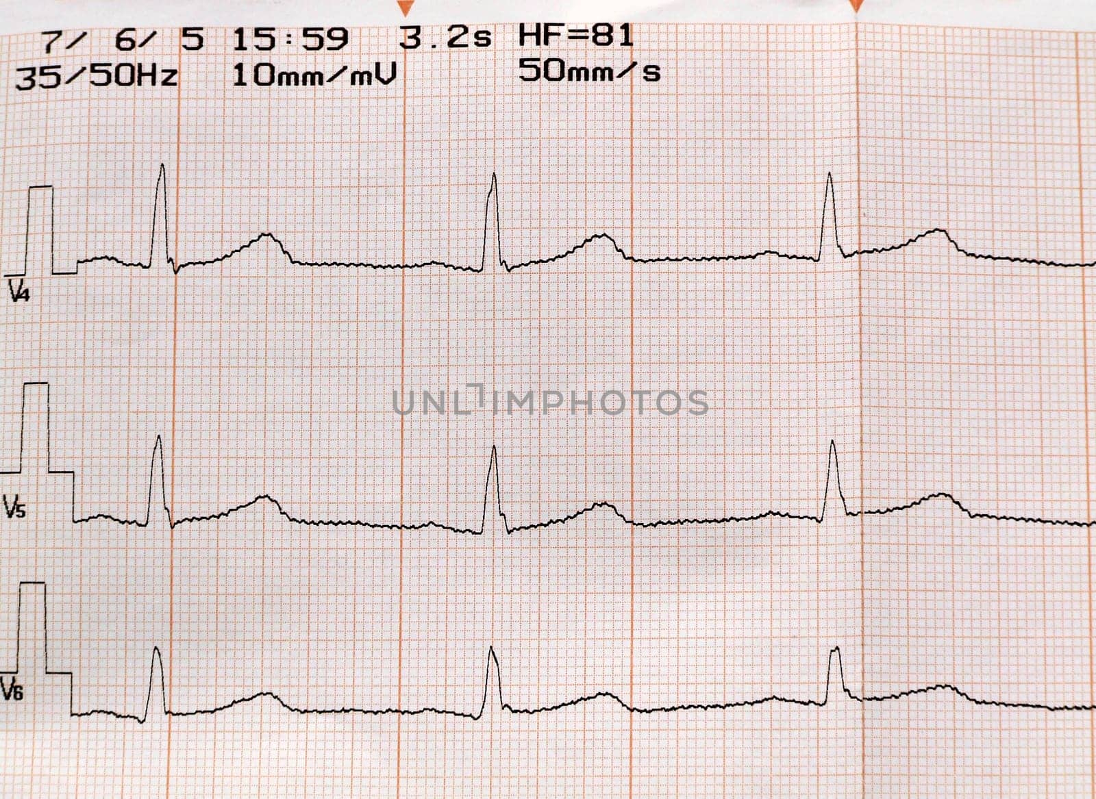 ELECTROCARDIOGRAM