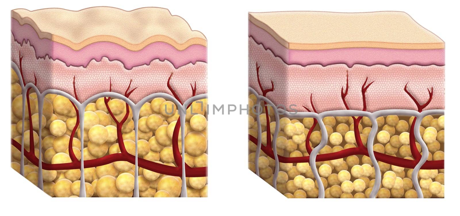 cellulite